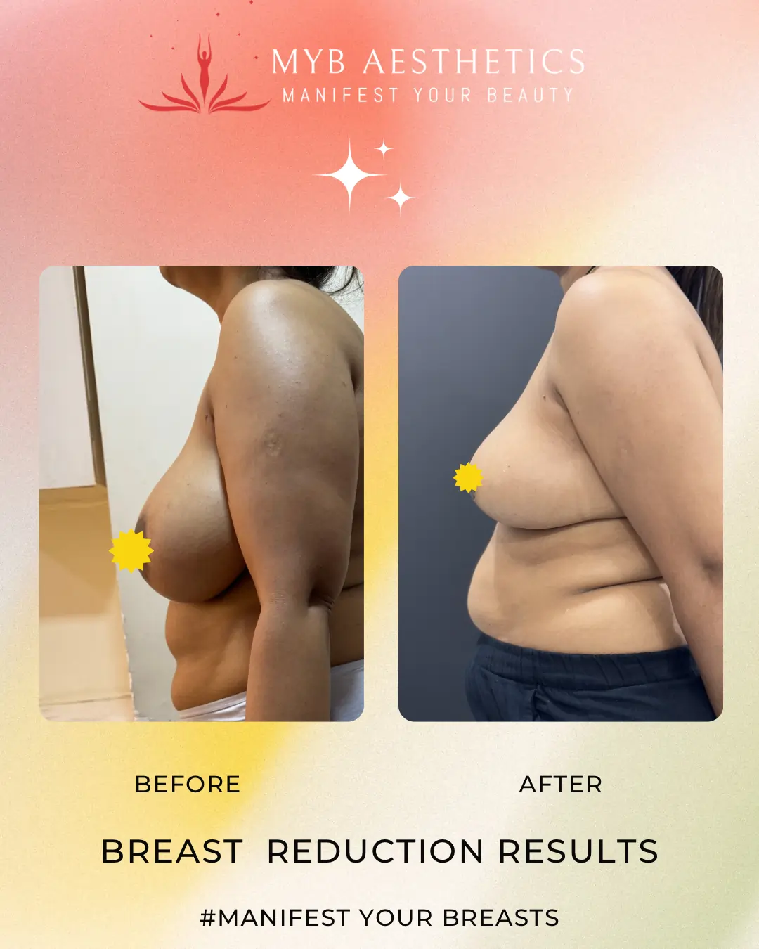 Best Breast Reduction Surgery in Mumbai