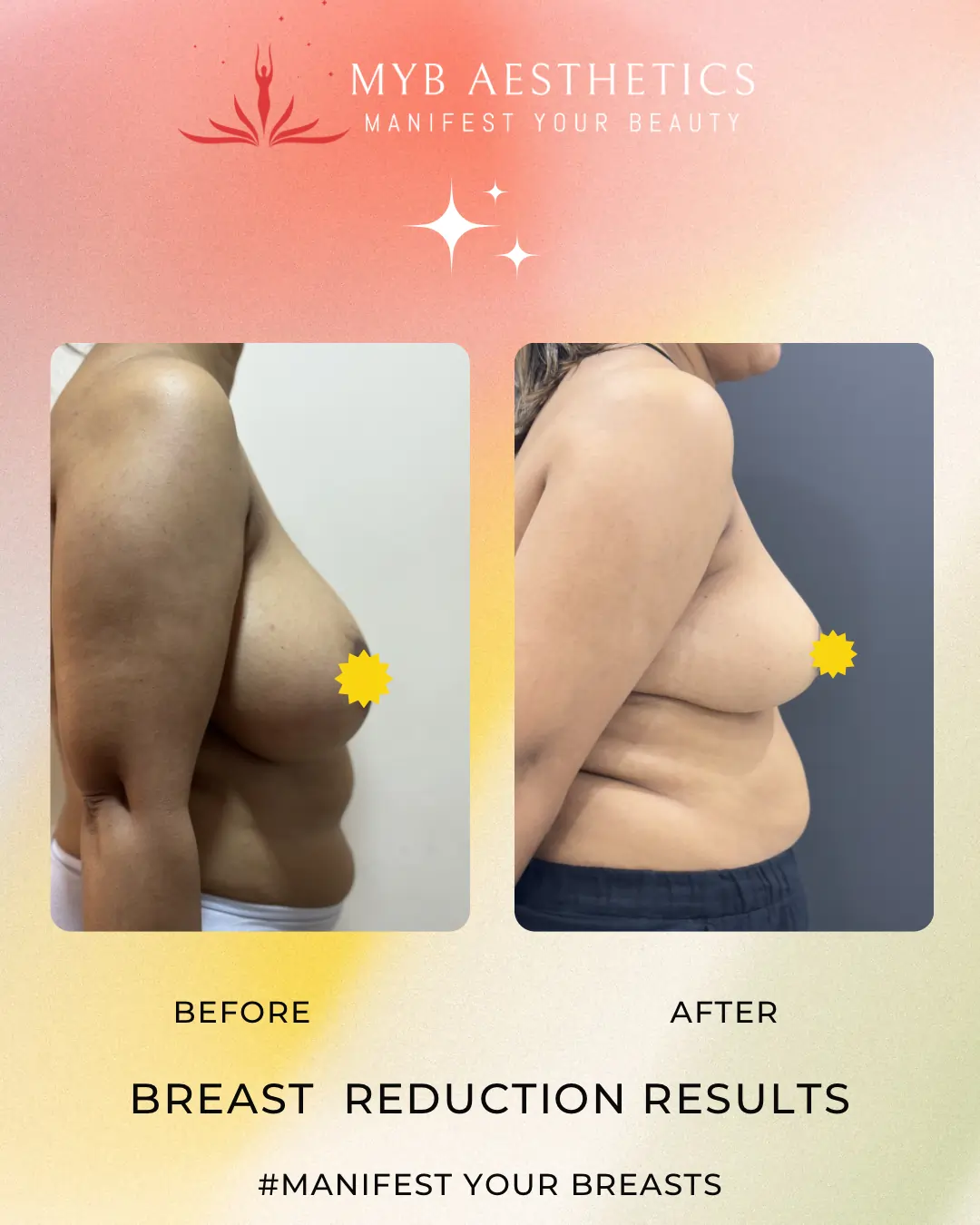 Best Breast Reduction Surgery Results in Mumbai. Before & After pics of Breast Reduction Surgery
