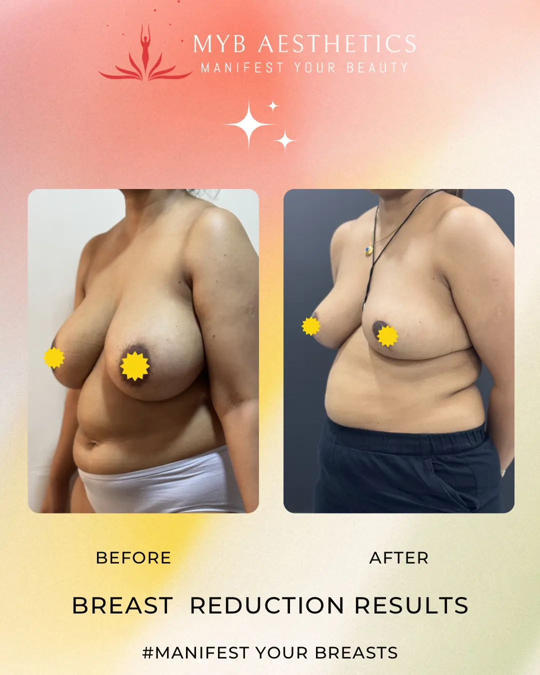 Breast Reduction Results Before & After pics