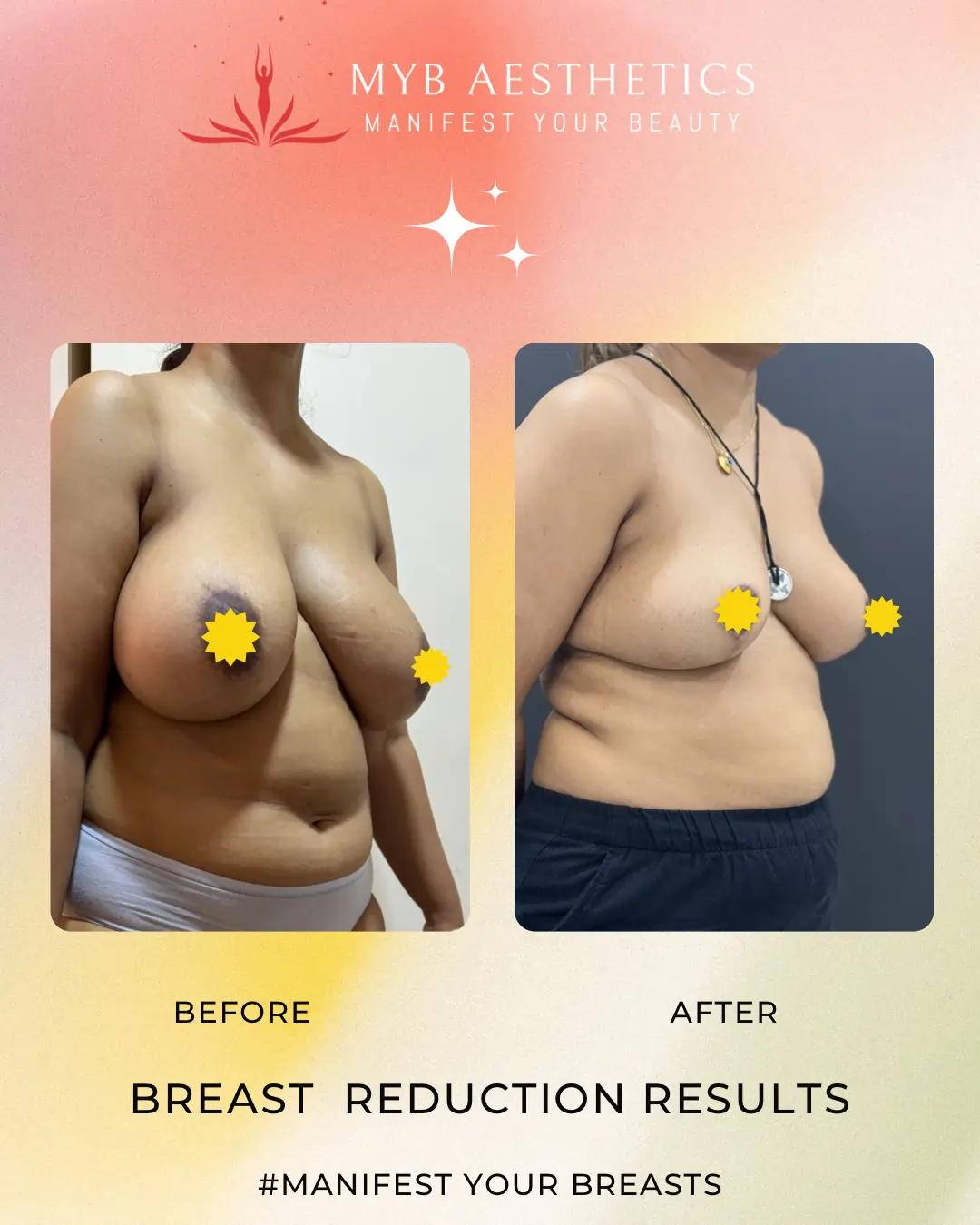 Best Breast Reduction Surgery Results in Mumbai
