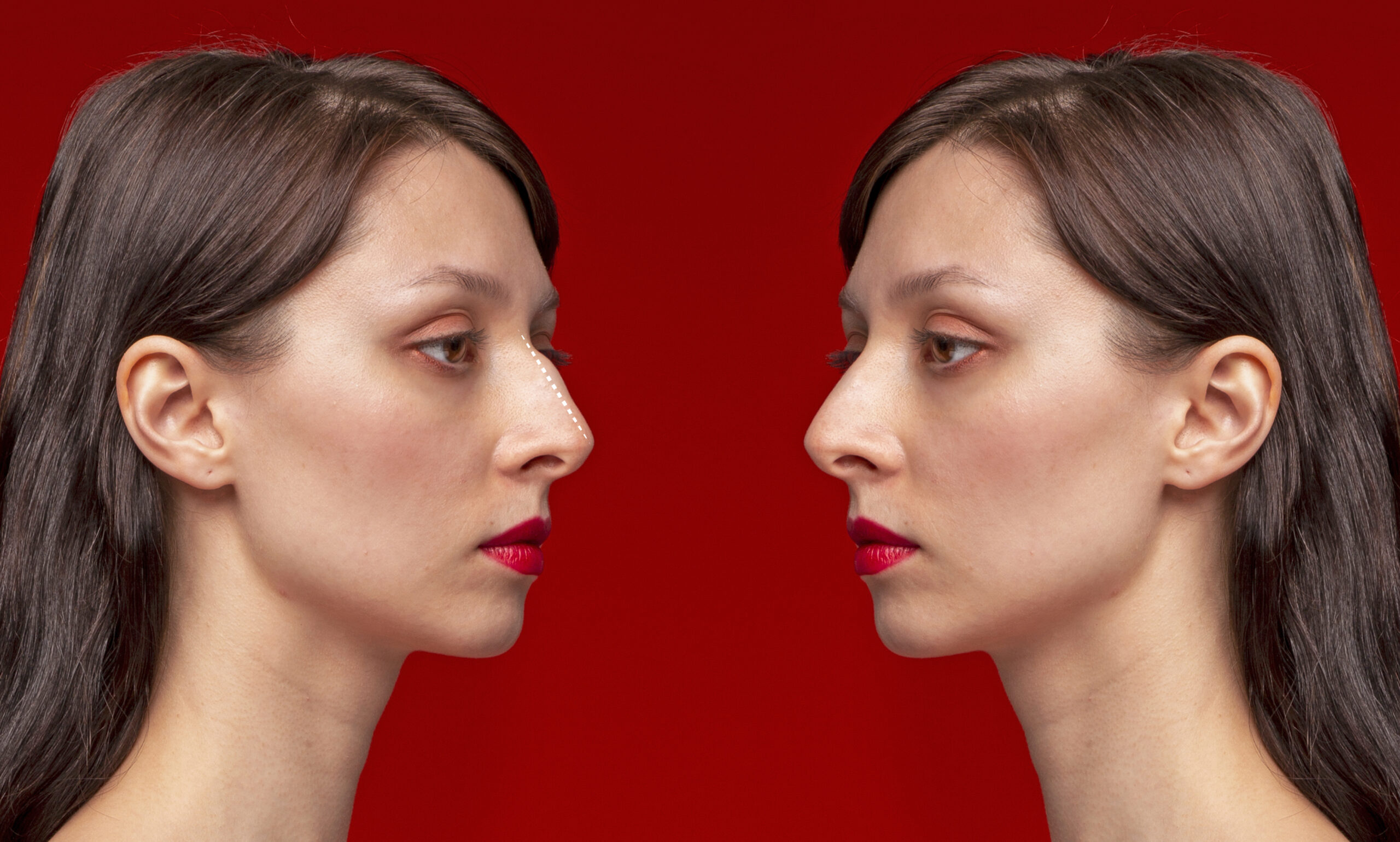 Open vs Closed Rhinoplasty: Pros, Cons & Recovery Explained