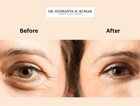 Eyelid crease enhancement with blepharoplasty surgery to make eyes look bigger and natural