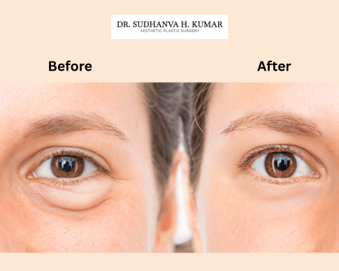 Eyelid surgery before and after treatment of dark circles, eye bags, and lateral brow drooping