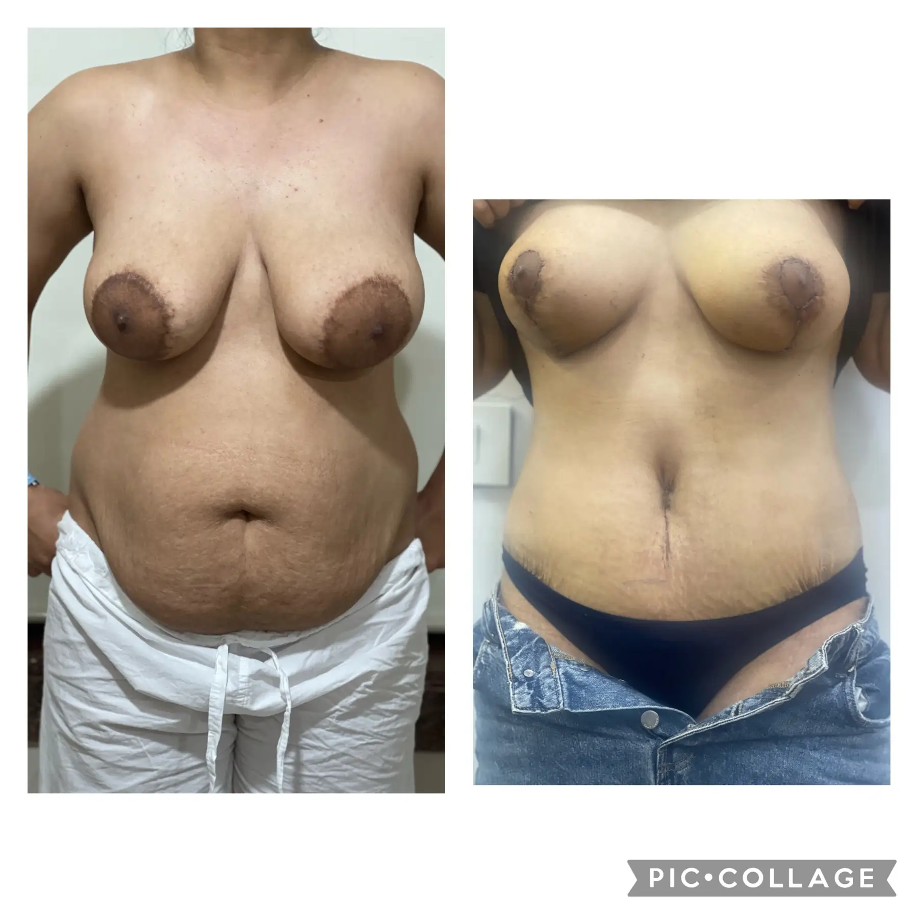 Tummy tuck with Breast lift surgery front profile. before & after pics