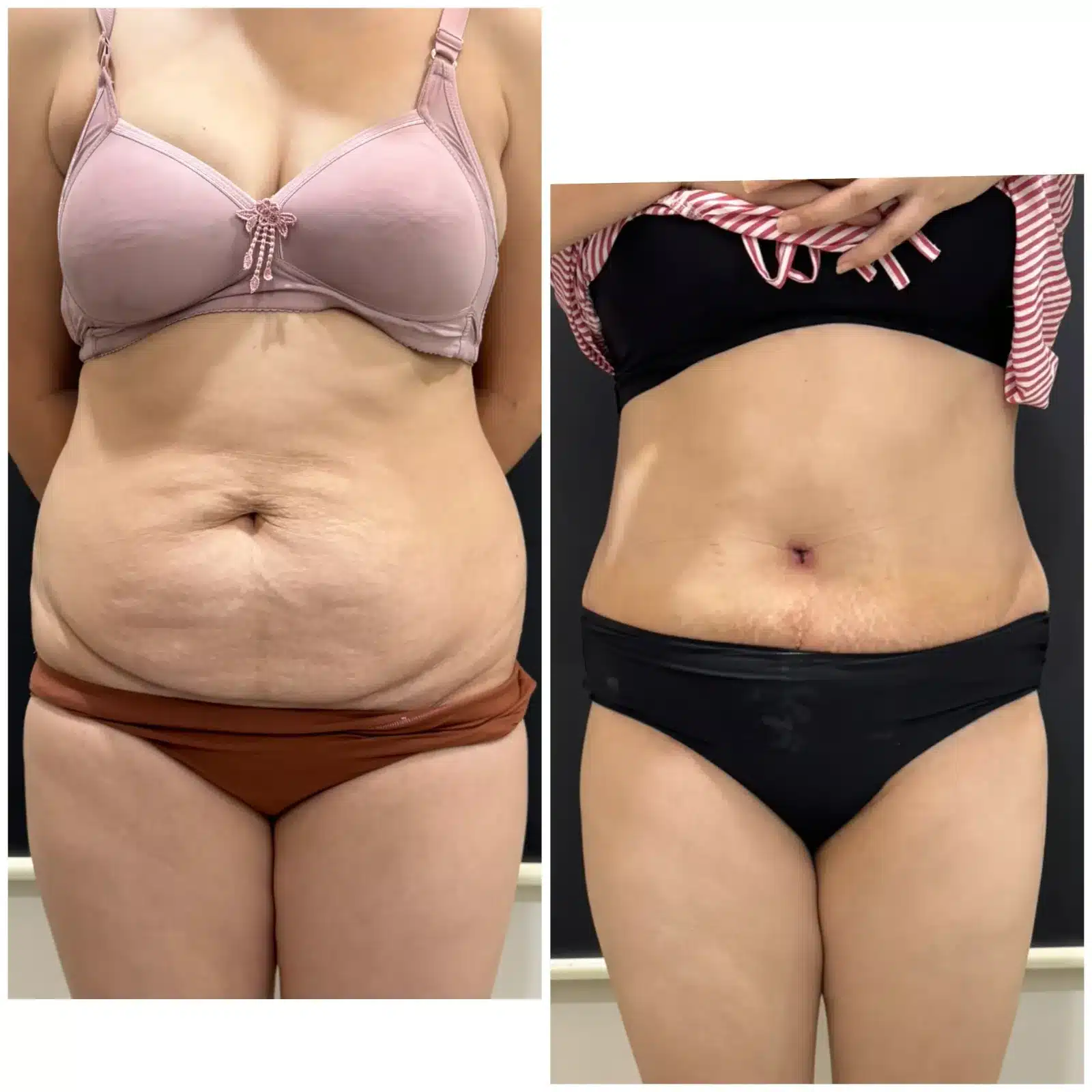 Before & after pic of tummy tuck result front profile.