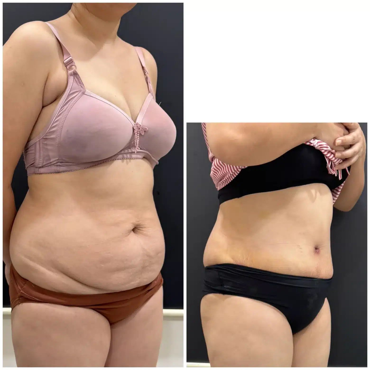 Before & after pic of tummy tuck result left lateral profile