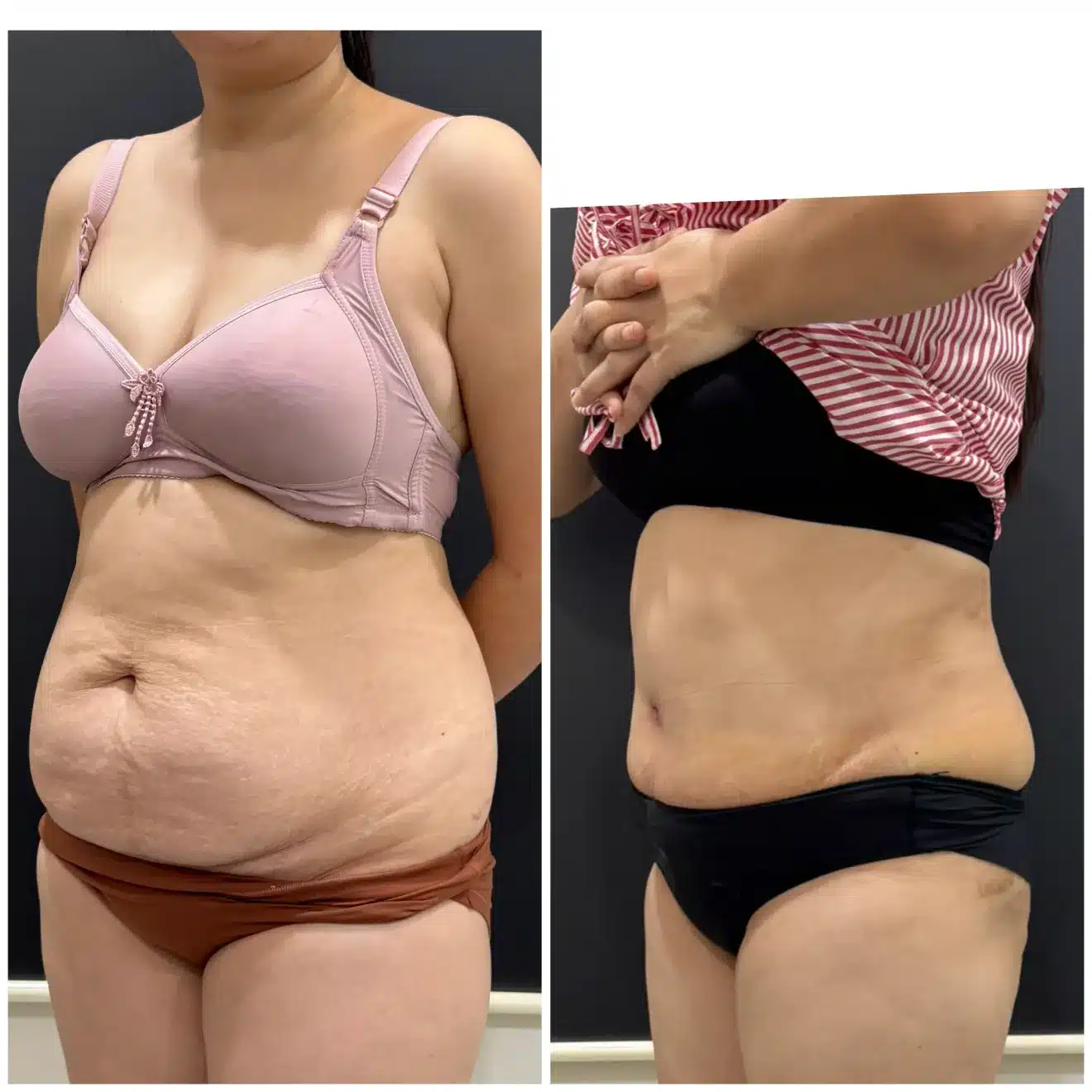 Before & after pic of tummy tuck result right lateral profile