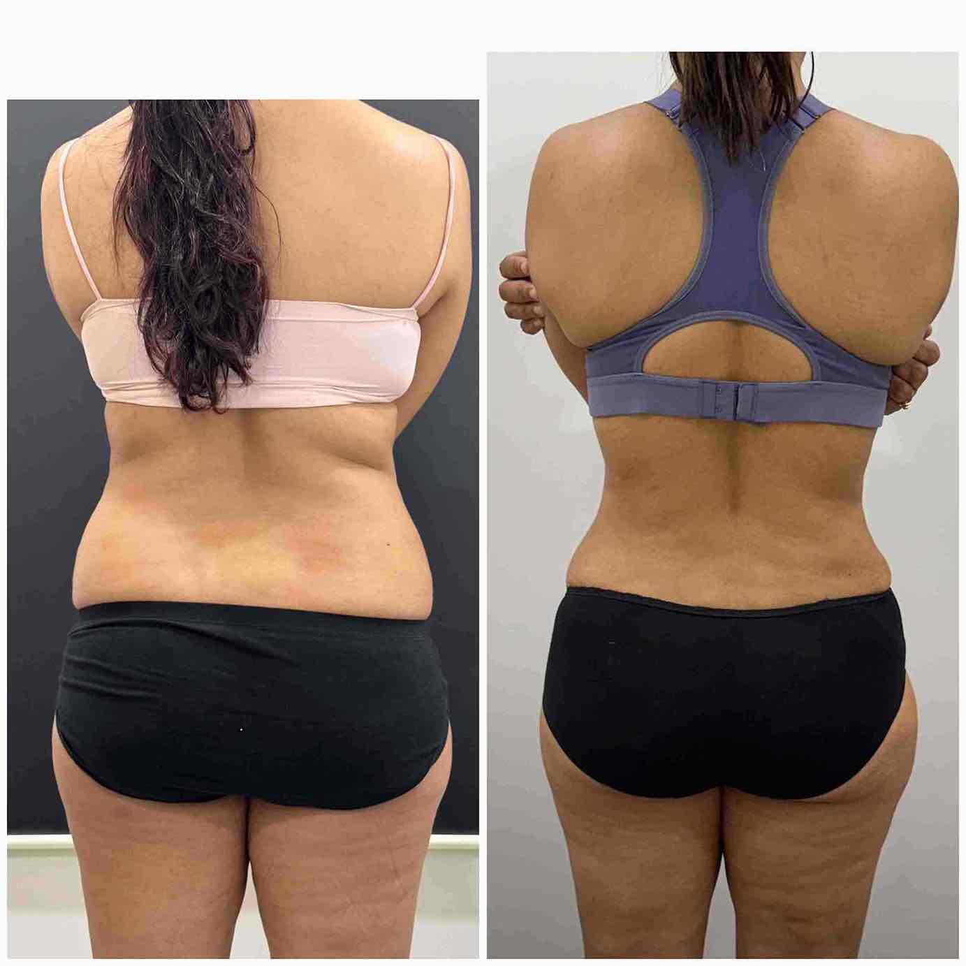 Best results for Tummy tuck in Mumbai before & after pics back profile