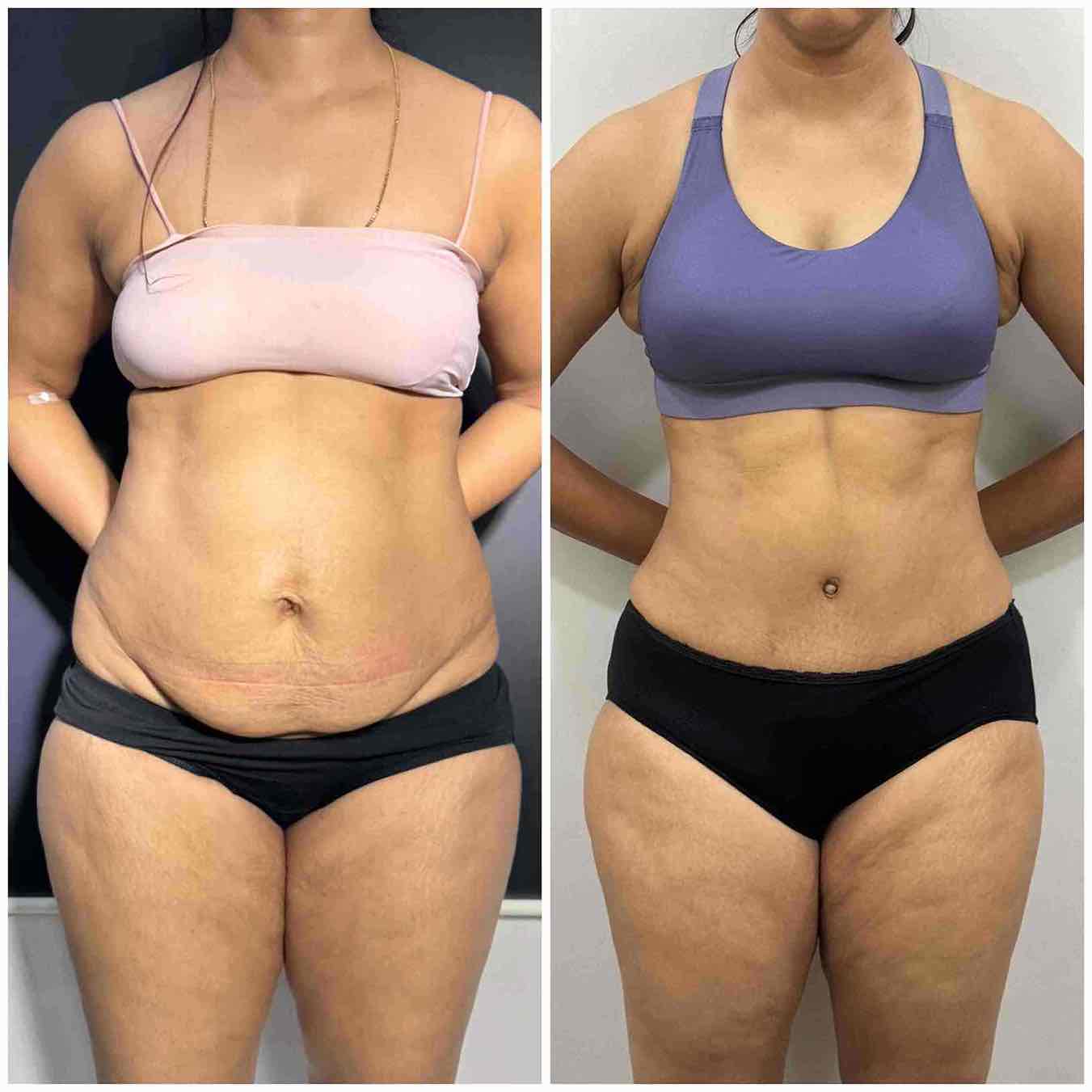 Best results for Tummy tuck in Mumbai before & after pics front profile