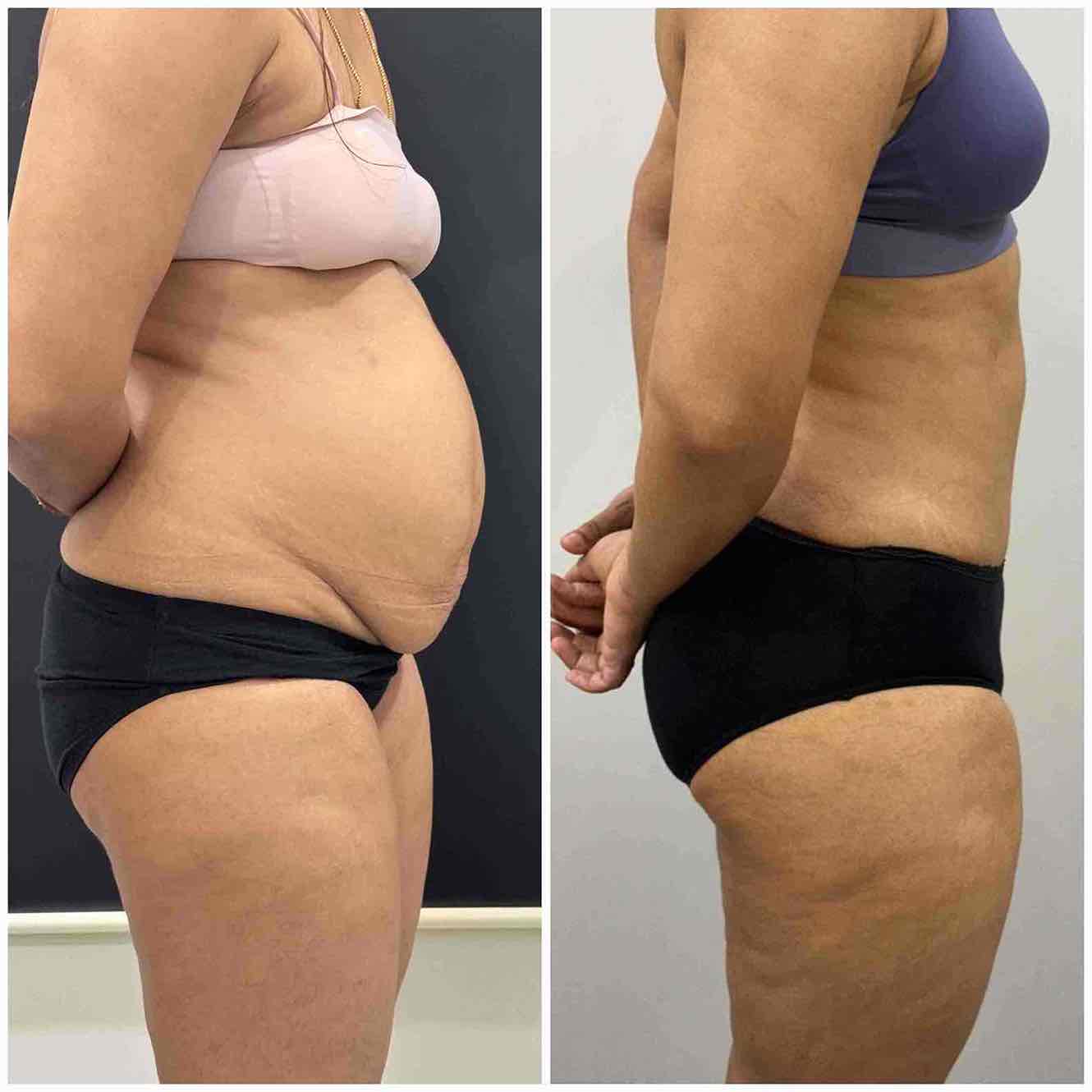 Best results for Tummy tuck in Mumbai before & after pics left side profile