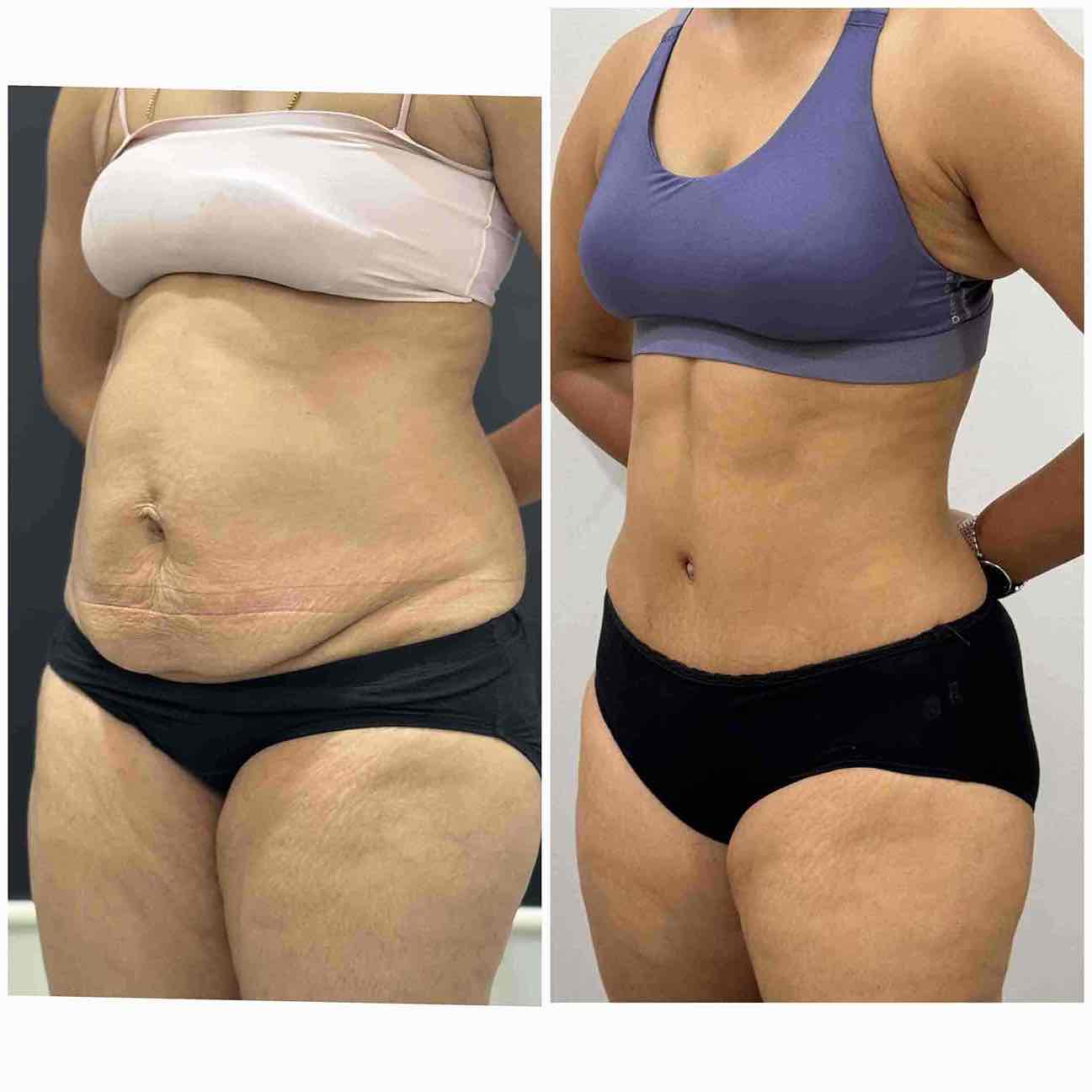 Best results for Tummy tuck in Mumbai before & after pics right lateral profile