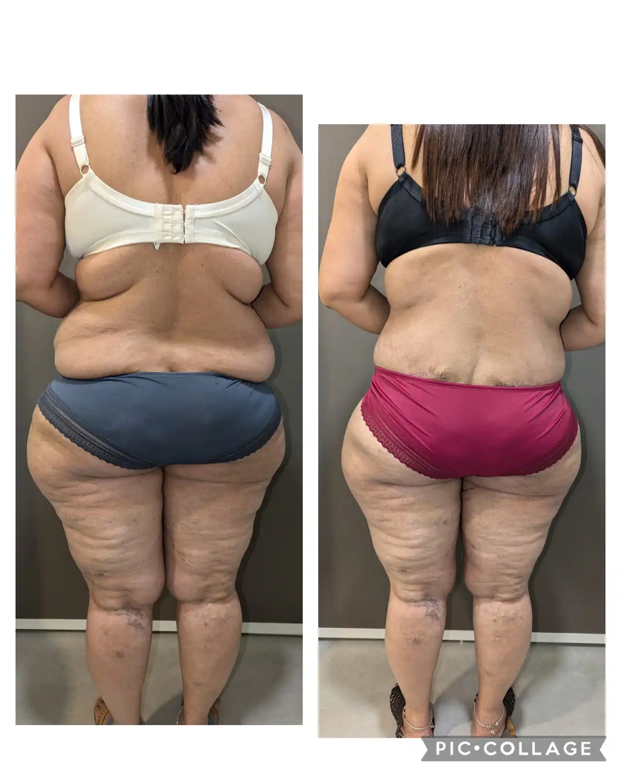 before & after pics of tummy tuck result back