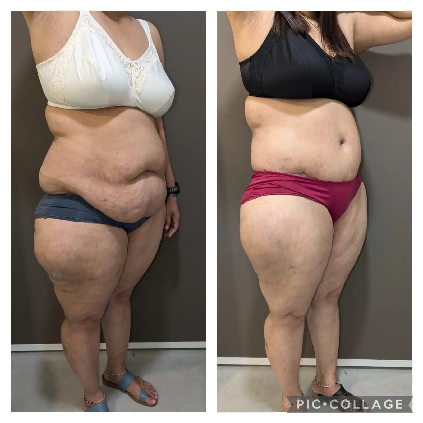 TUMMY TUCK RESULT BEFORE & AFTER PICS LEFT LATERAL PROFILE