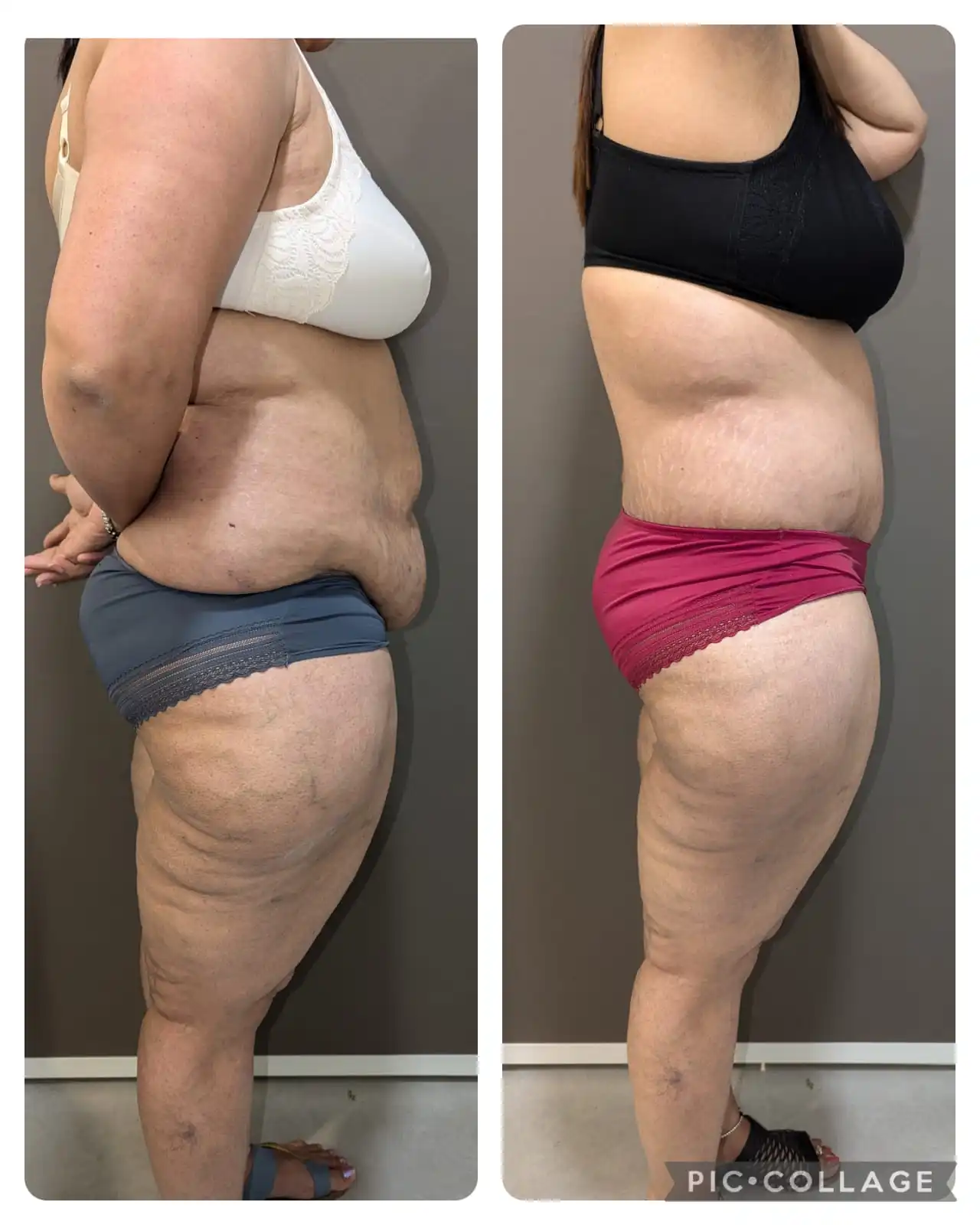 before & after pics of tummy tuck left side