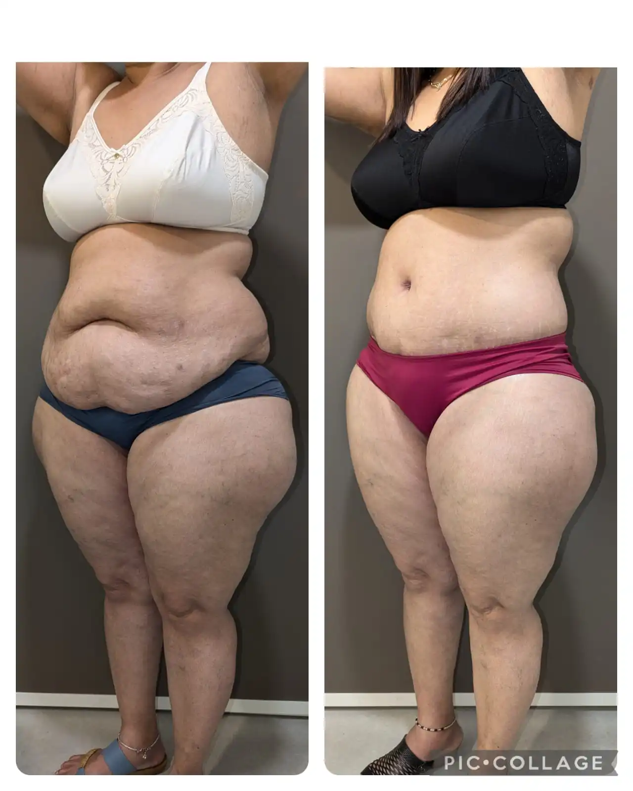 Tummy tuck result before & after pics right lateral