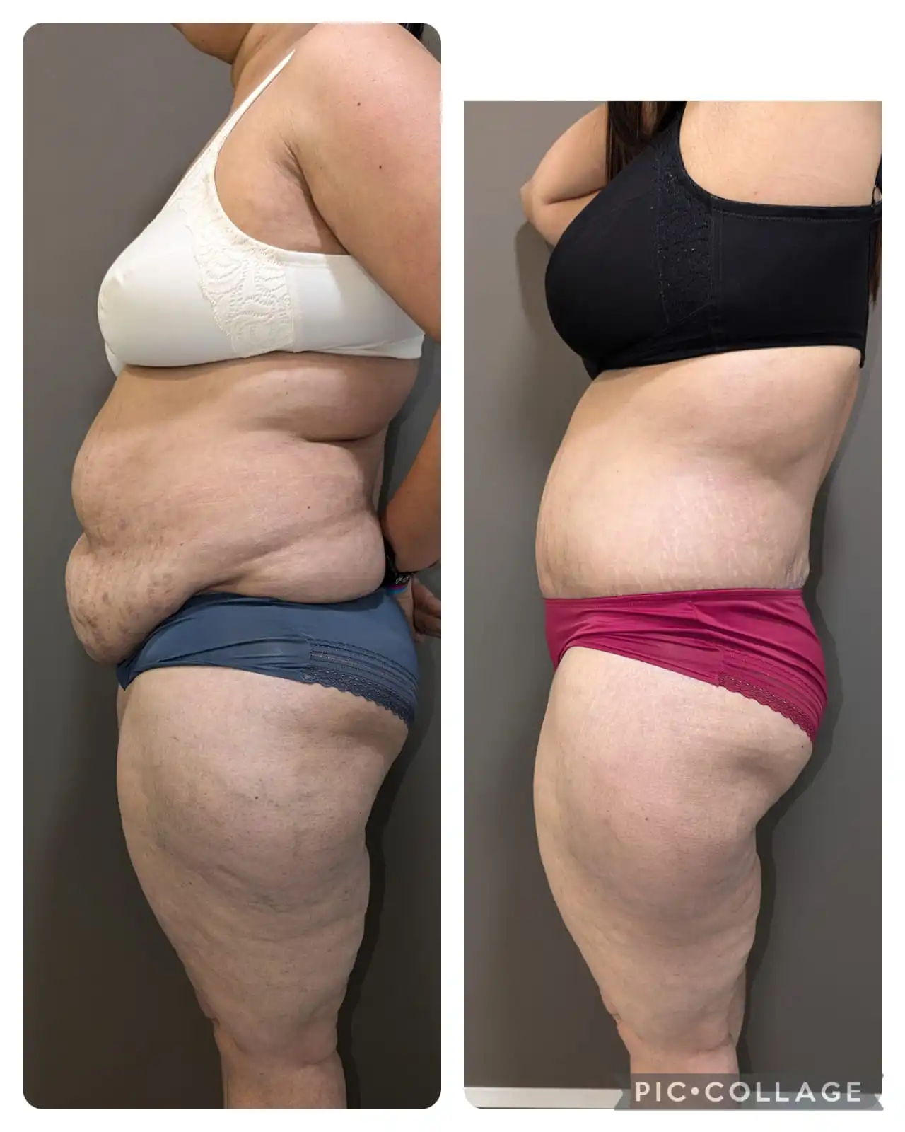 before & after pics of tummy tuck right side