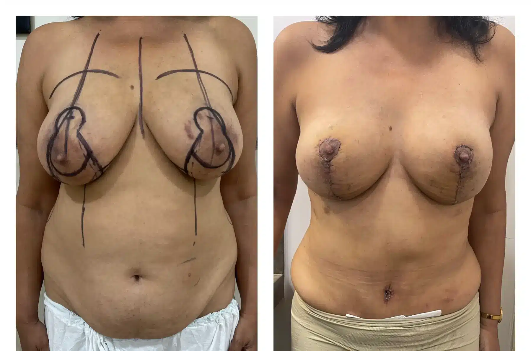 Before & after pic of Tummy tuck with Breast lift front profile