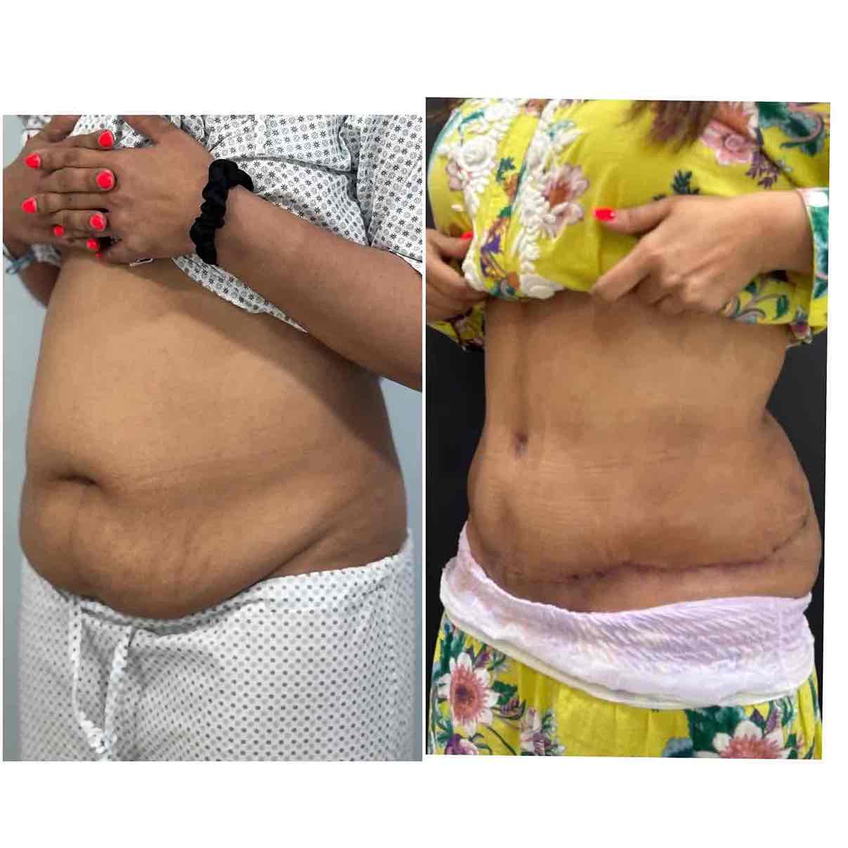before and after pic of tummy tuck result right lateral