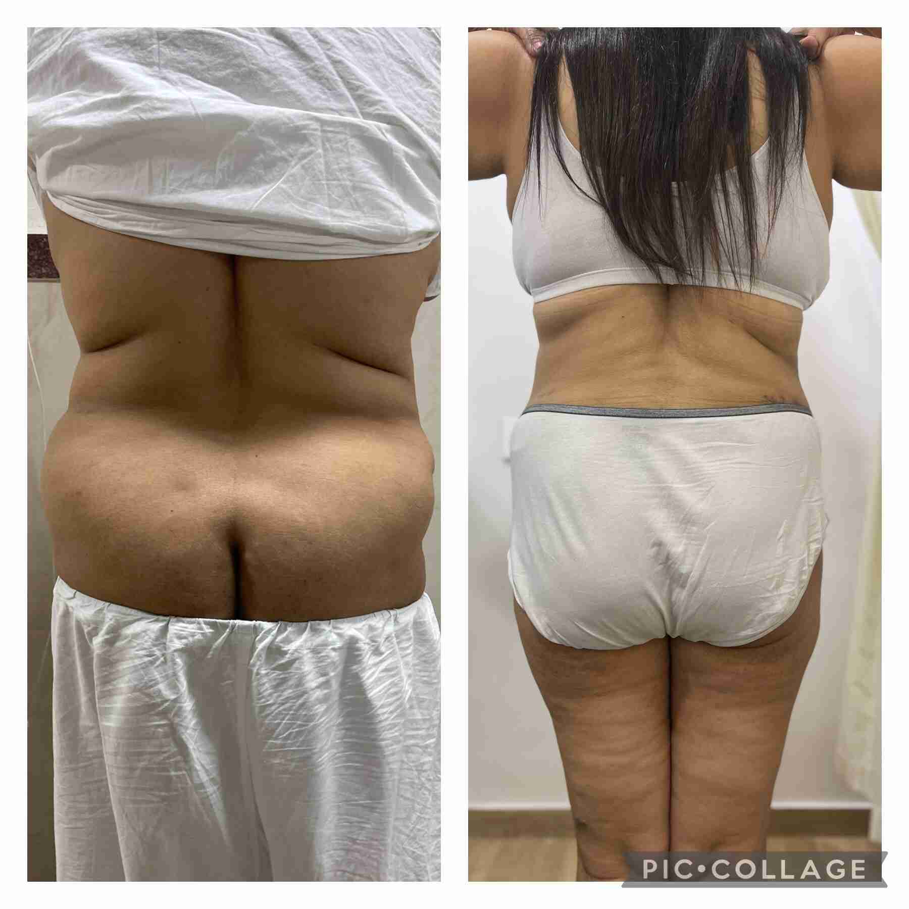 tummy tuck before and after pics India back profile