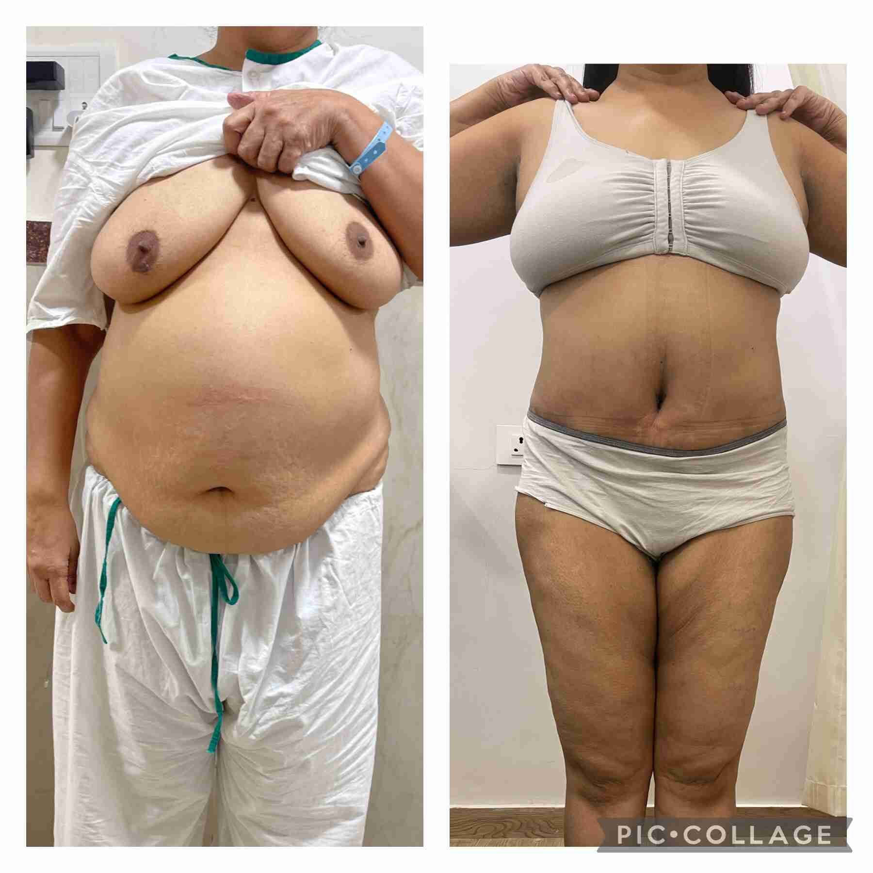 tummy tuck before and after pics India front profile