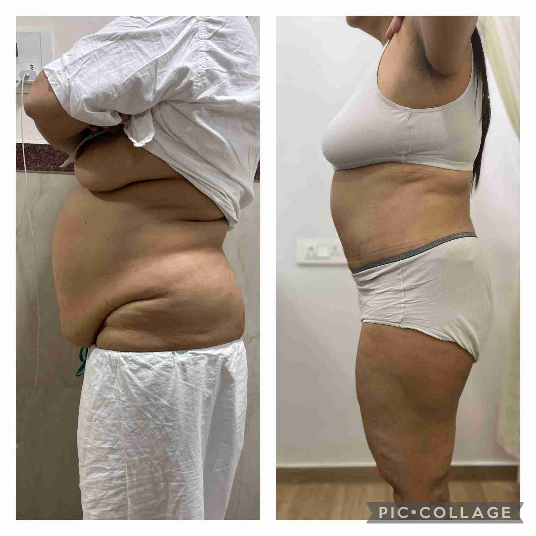 tummy tuck before and after pics India right profile