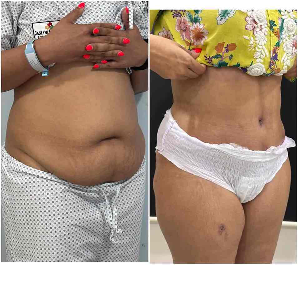 before and after pic of tummy tuck result left lateral