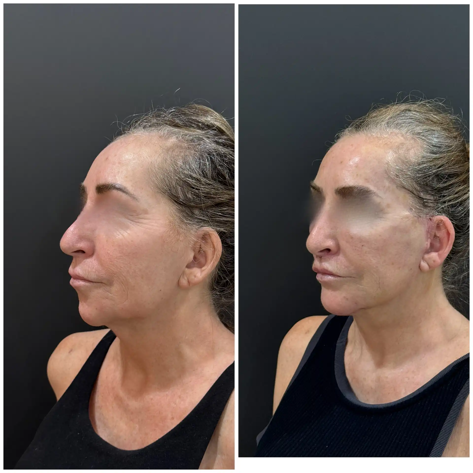 Deep plane Face Lift Result In Mumbai, India. Before & After Pic