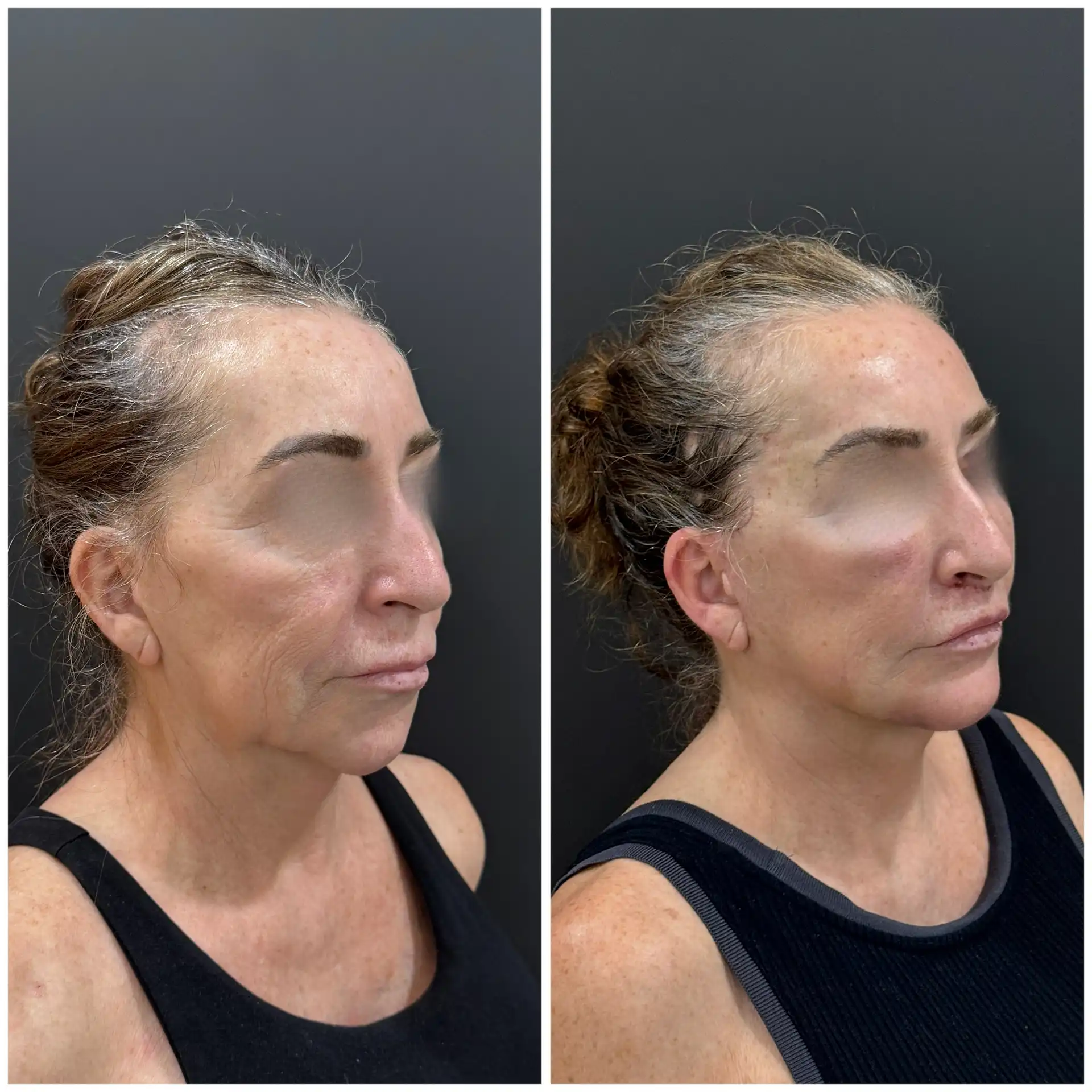 Deep plane Face Lift Result In Mumbai, India. Before & After Pic
