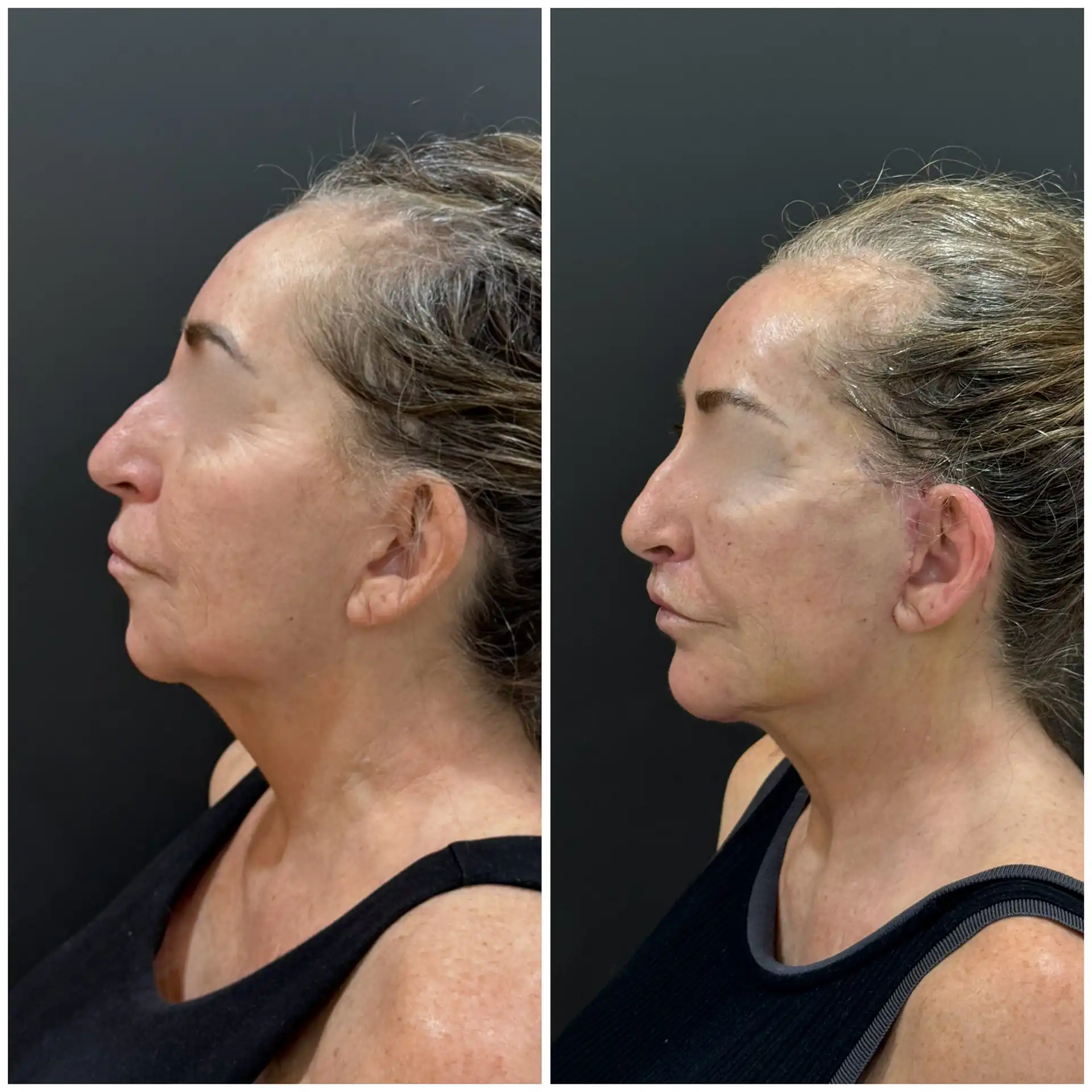 Deep plane Face Lift Result In Mumbai, India. Before & After Pic