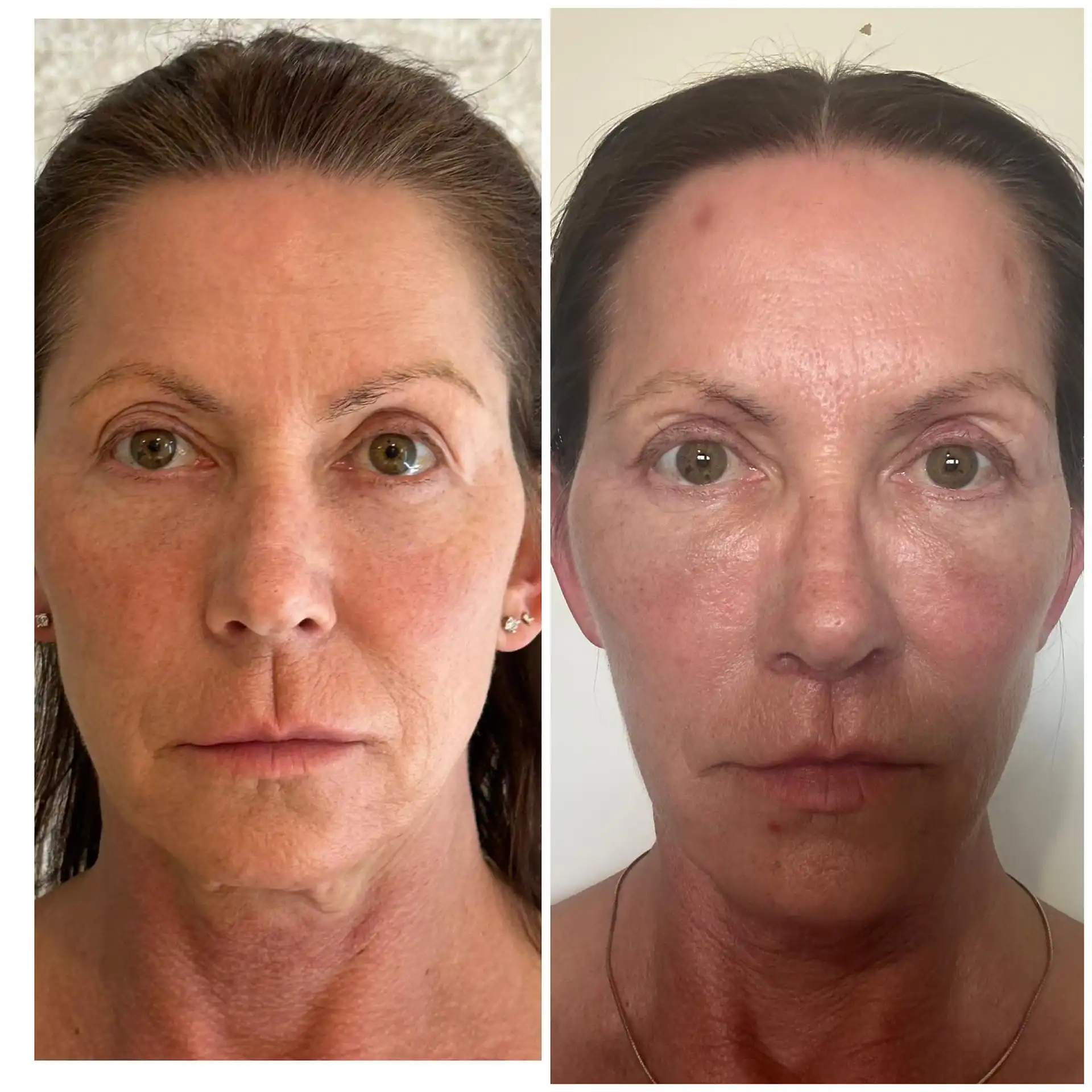Best Plastic Surgeon for Deep plane Face Lift In Mumbai, India. Before & After Results