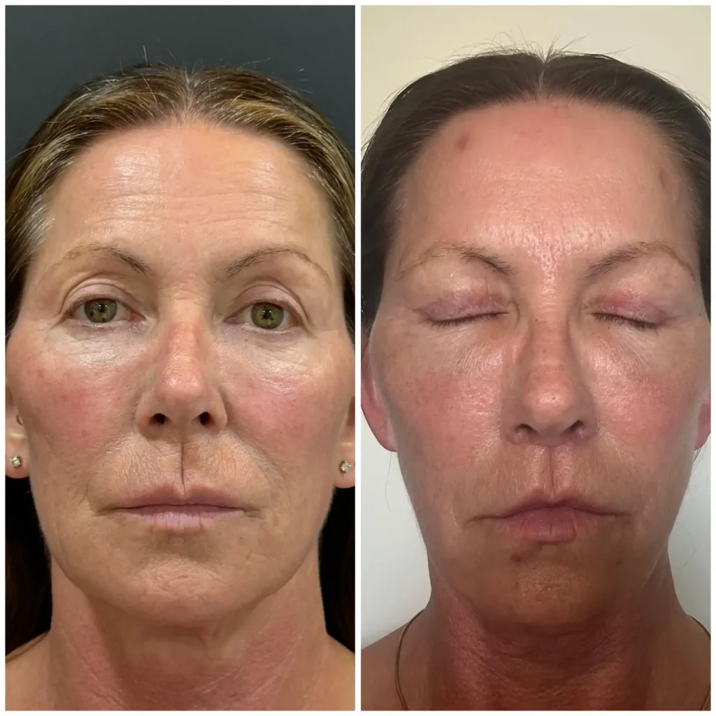Best Plastic Surgeon for Deep plane Face Lift In Mumbai, India. Before & After Results