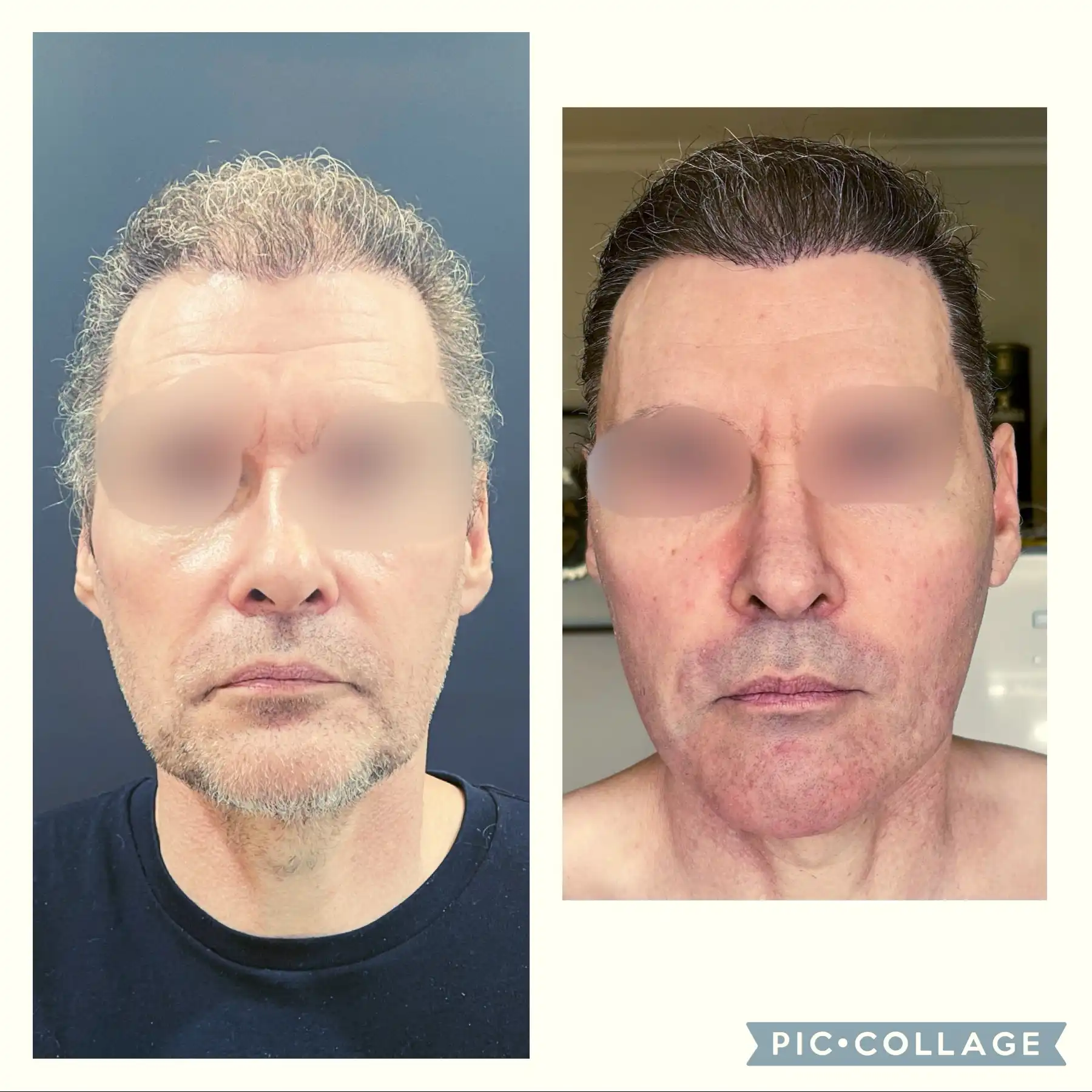 Male Deep plane Facelift result before & after pic front profile