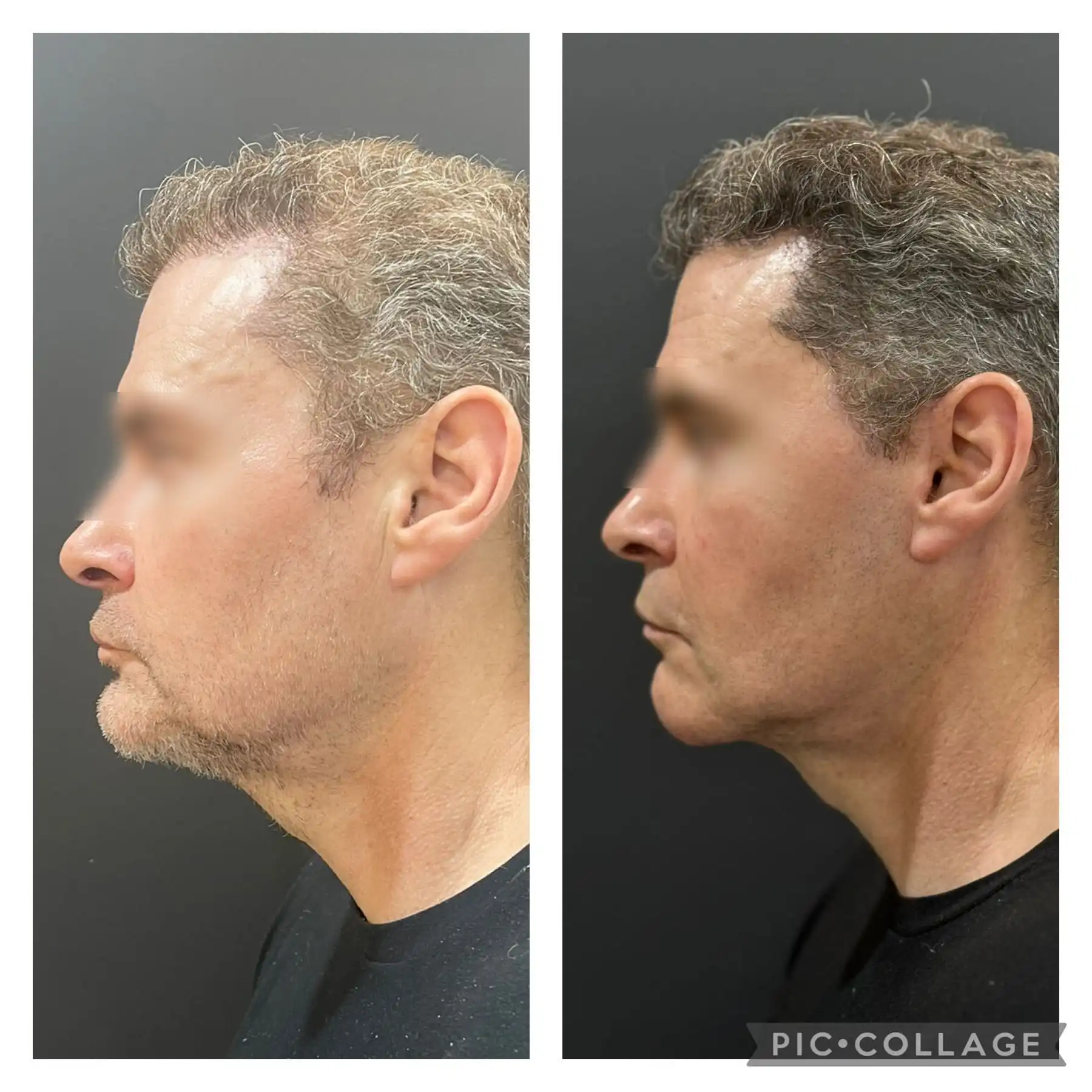 Male Deep plane Facelift result before & after pic left side profile