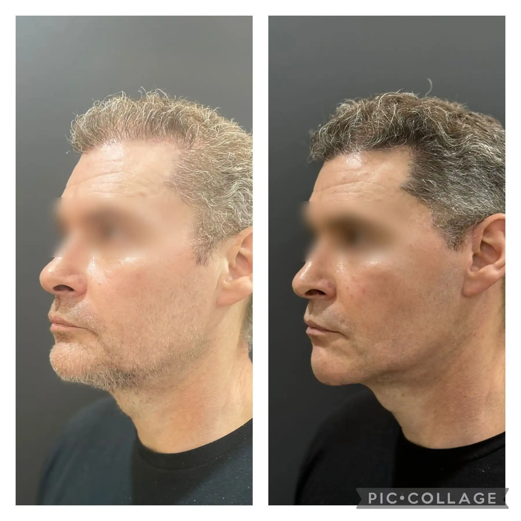 Male Deep plane Facelift result before & after pic left side profile