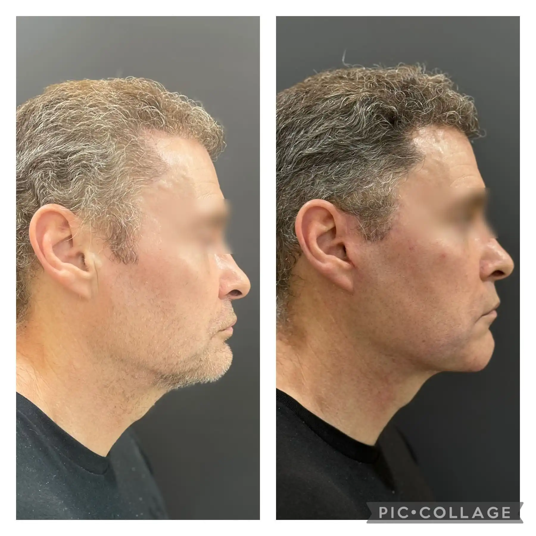 Male Deep plane Facelift result before & after pic right side profile