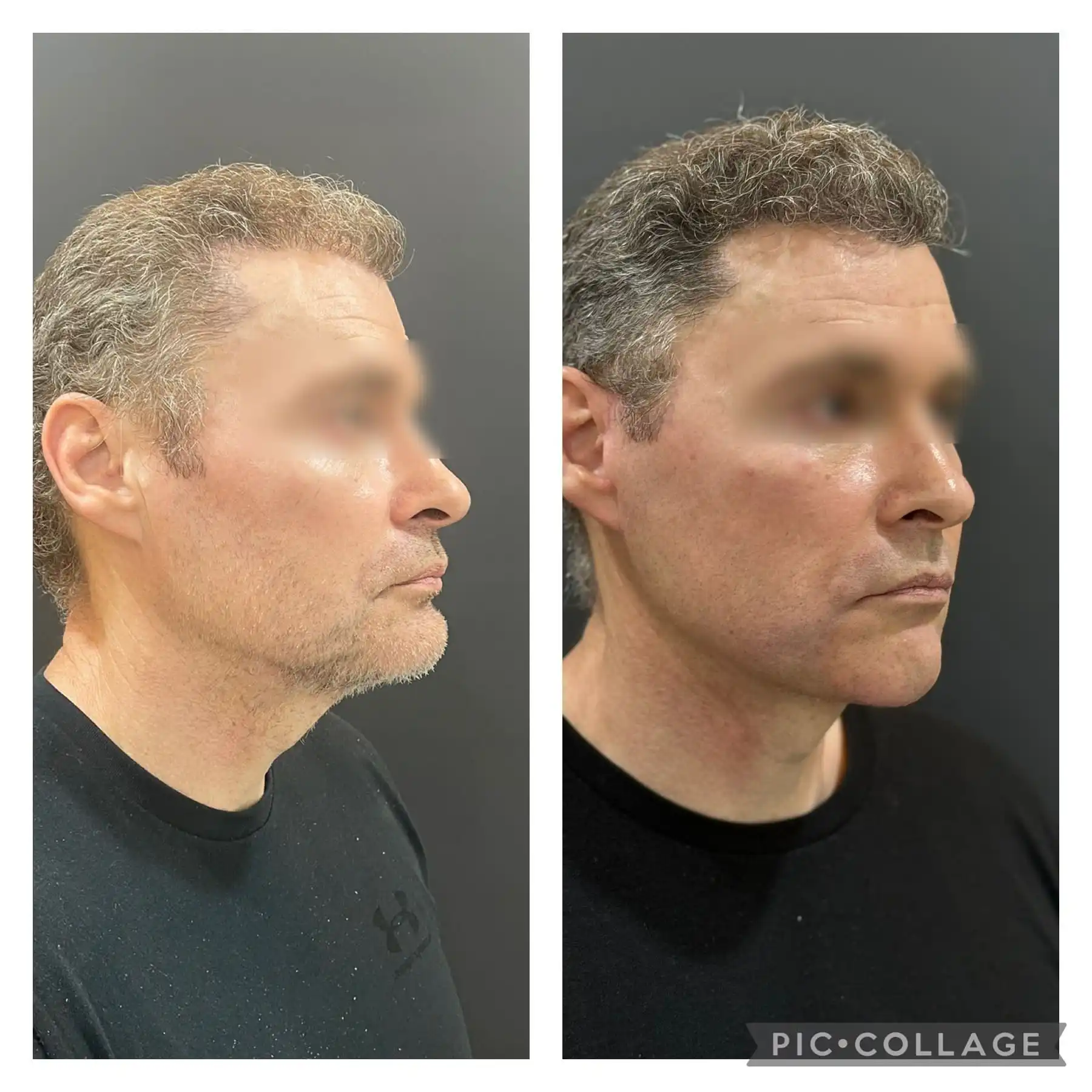 Male Deep plane Facelift result before & after image right side profile
