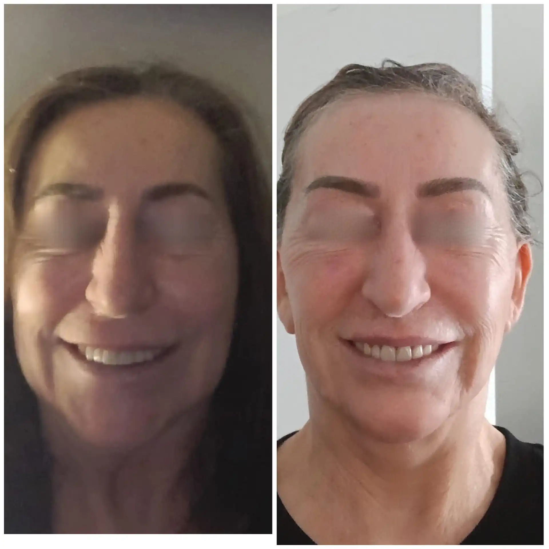 Deep plane Face Lift Result In Mumbai, India. Before & After Pic front profile