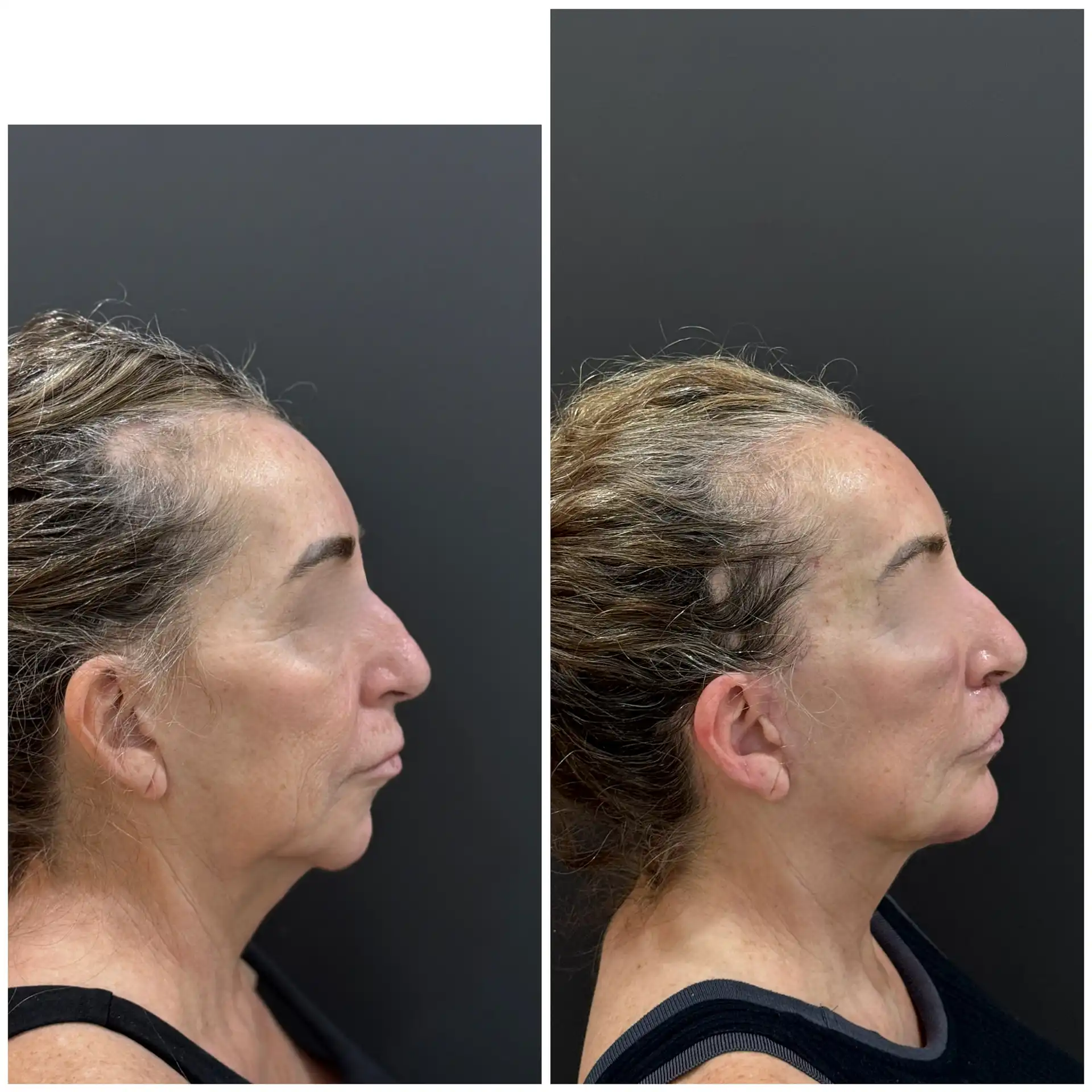 Deep plane Face Lift Result In Mumbai, India. Before & After Pic