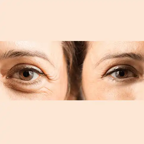 Upper Lid Blepharoplasty for loose droopy eyelid skin