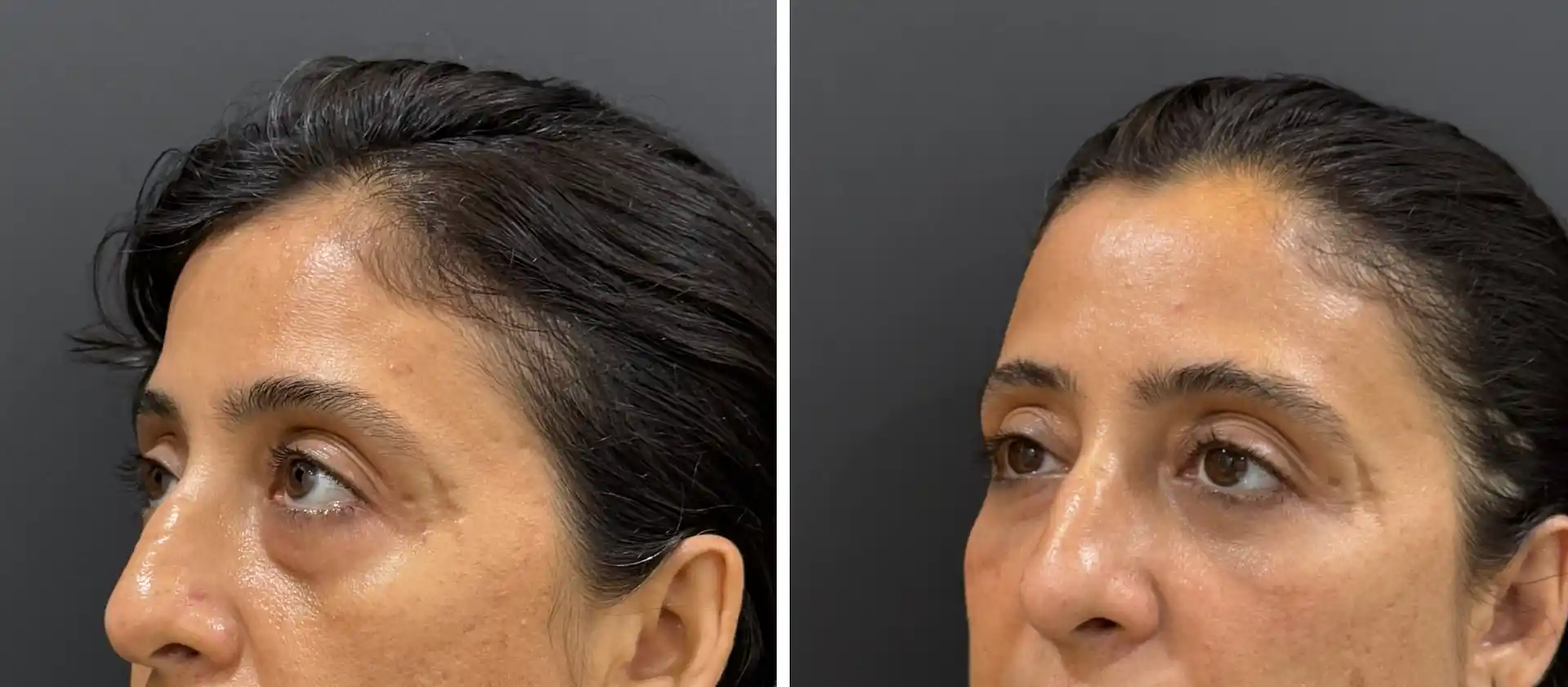 Lower Lid Blepharoplasty Result Before and after