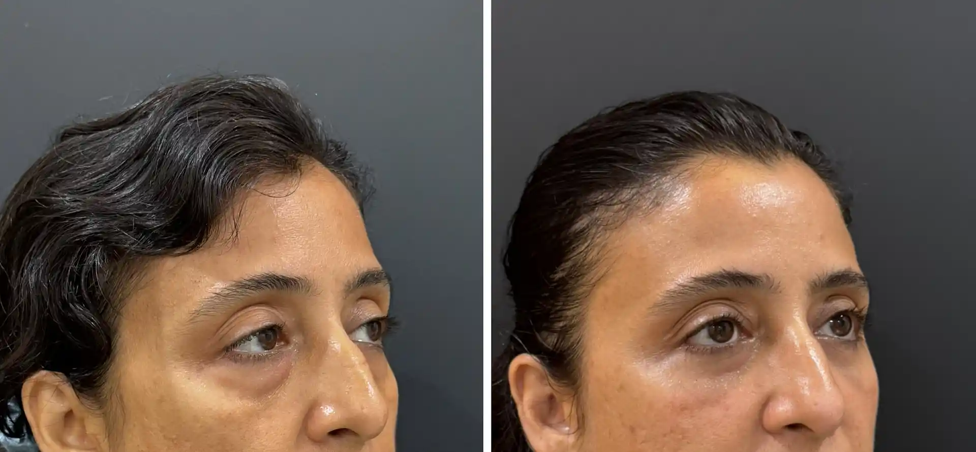 Lower Lid Blepharoplasty in Mumbai