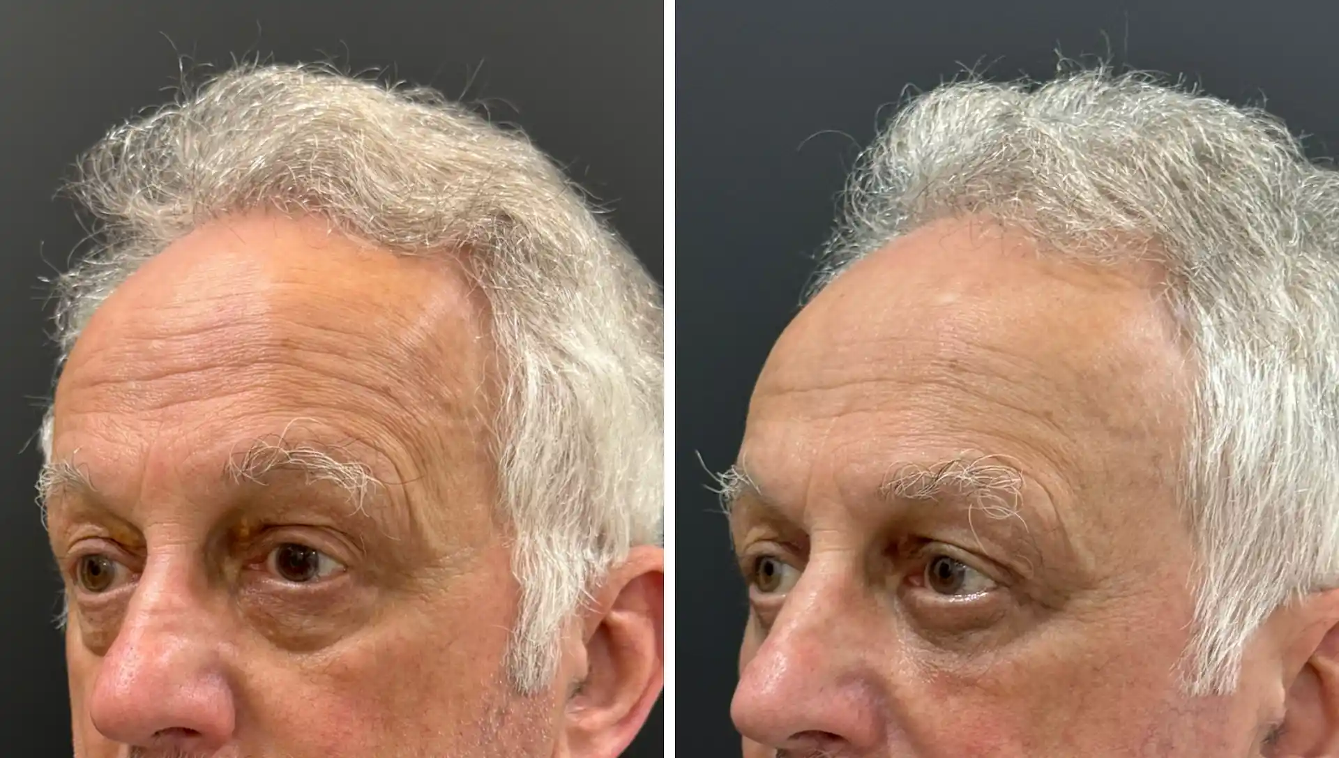 Under Eye Fat Bags Surgery in Mumbai, Before & after result