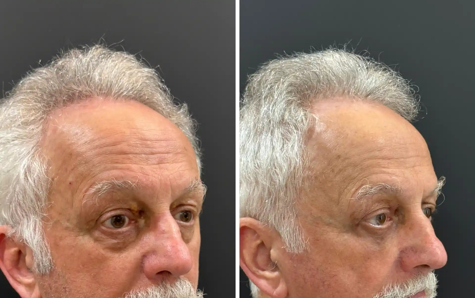 Under Eye Fat Bags Surgery in Mumbai, Before & after result