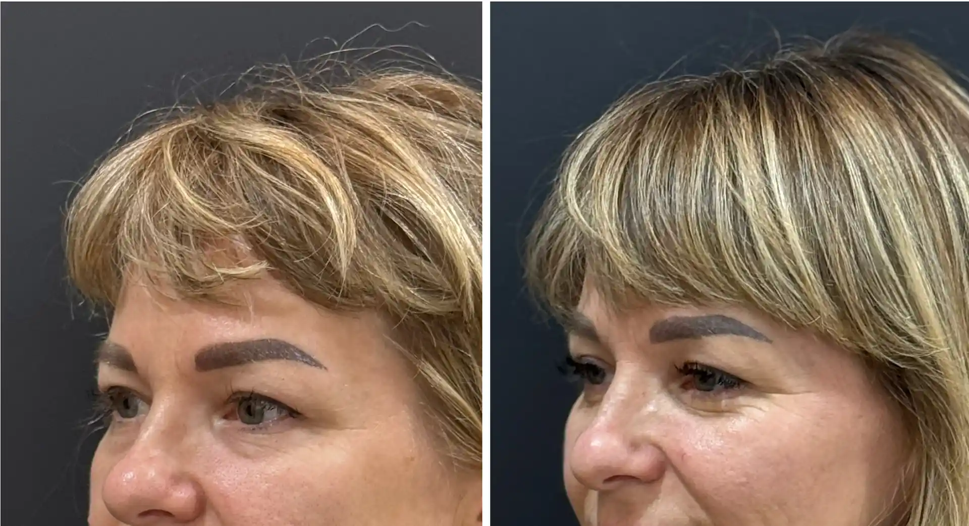 Blepharoplasty surgery in mumbai, Before and after