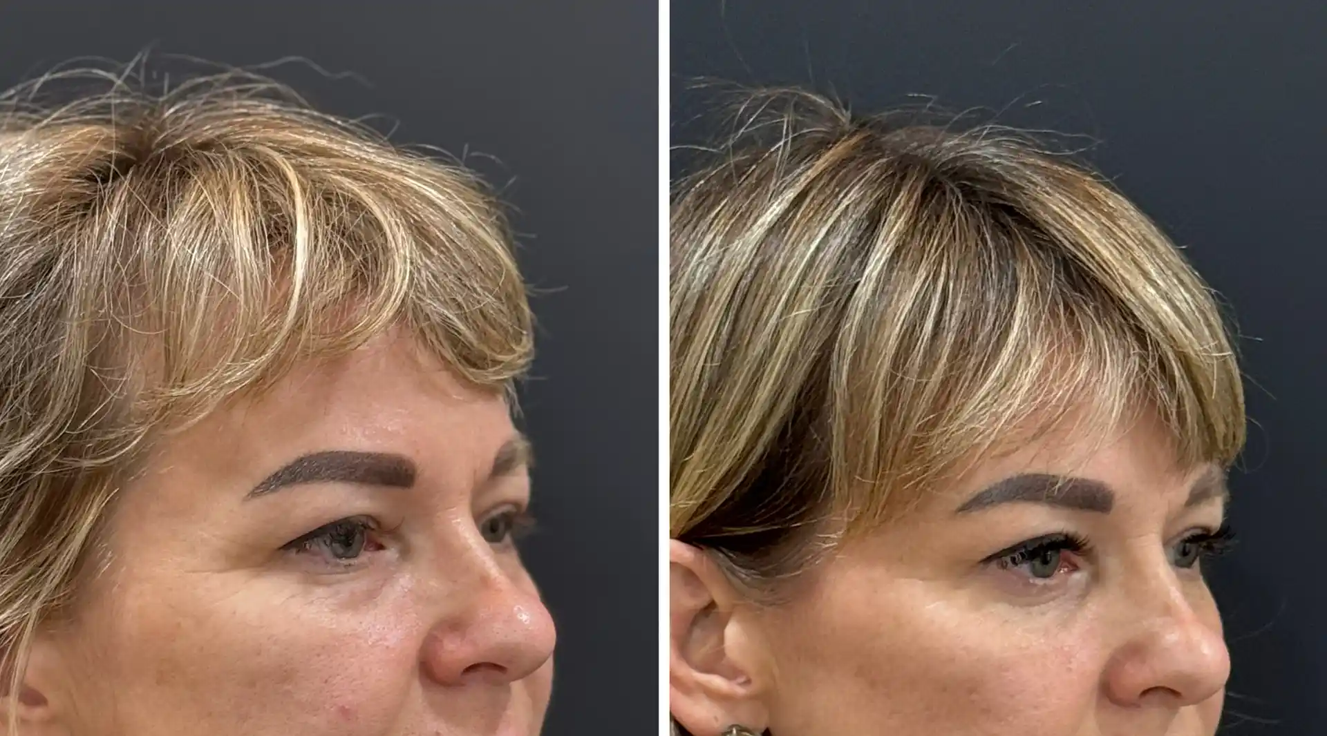 Blepharoplasty surgery in mumbai, Before and after