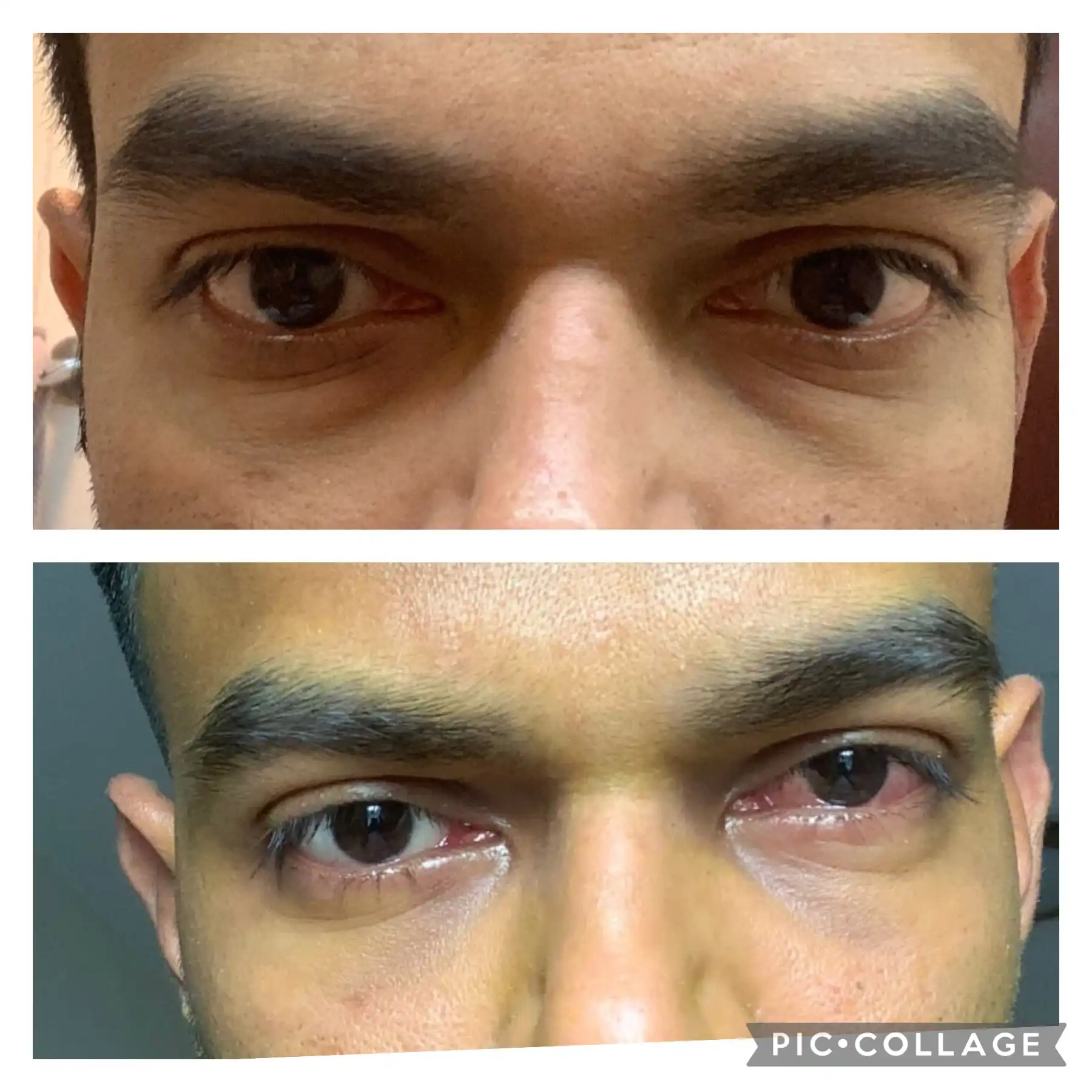 Under eye fat bags surgery before and after