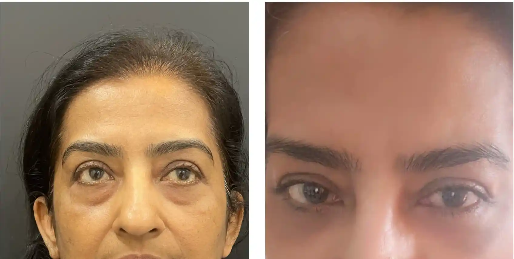 Best under eye fat bags surgery in India, Before & after
