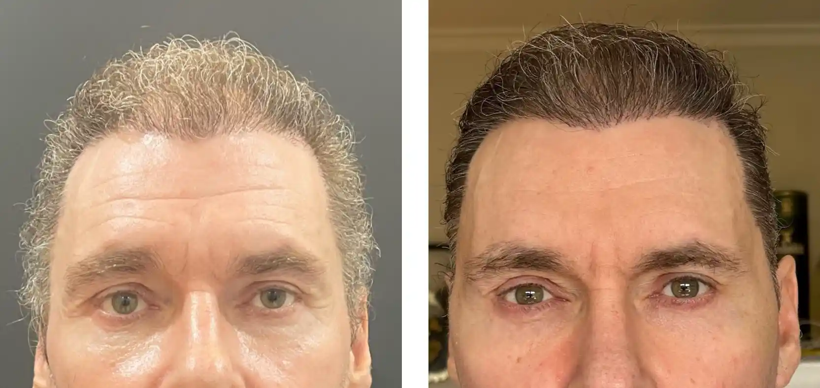 upper lid Blepharoplasty in Mumbai