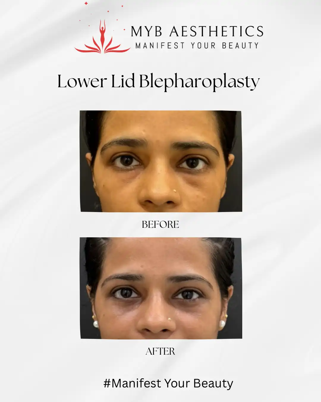 lower lid blepharoplasty before and after