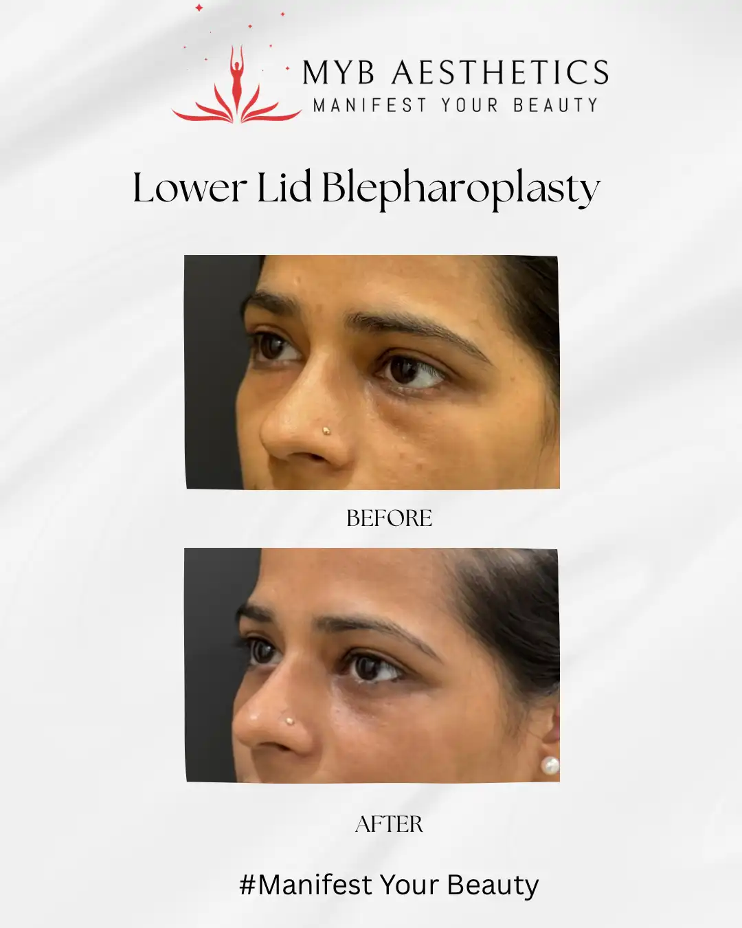 Under eye fat bags surgery before and after